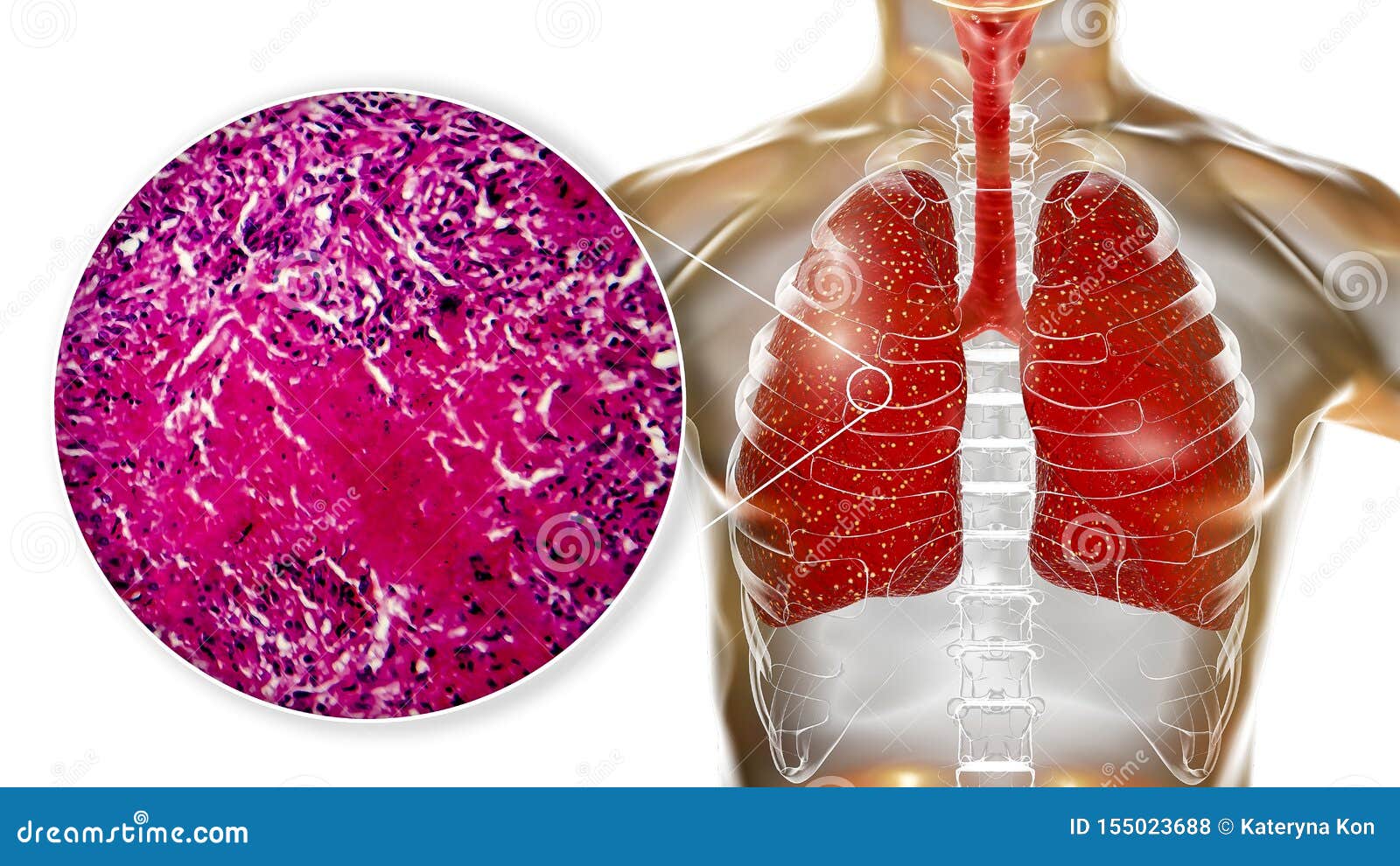 Tuberculose Miliary, Illustration Et Micrographe Léger ...