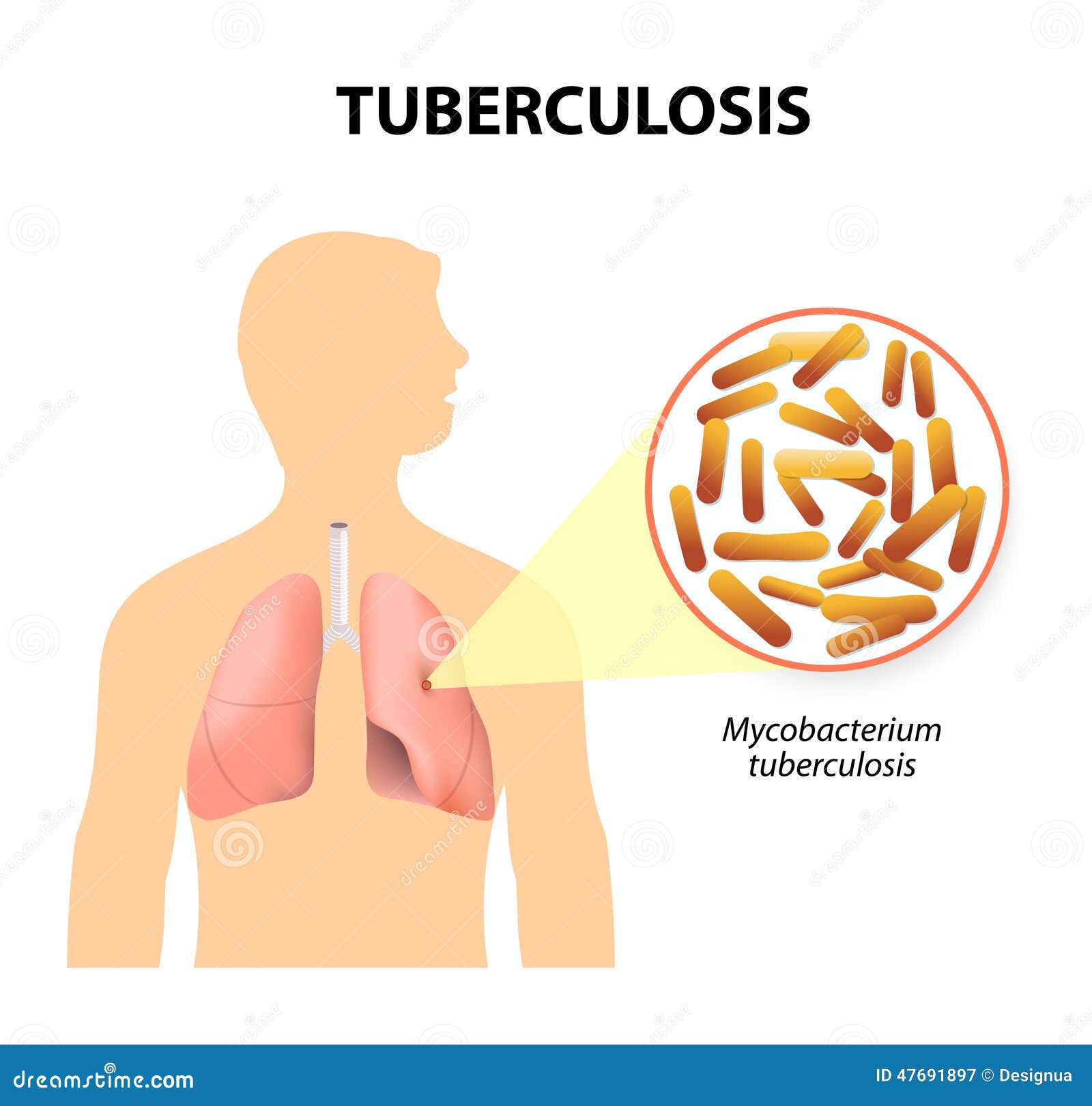 tuberculosis, mtb or tb