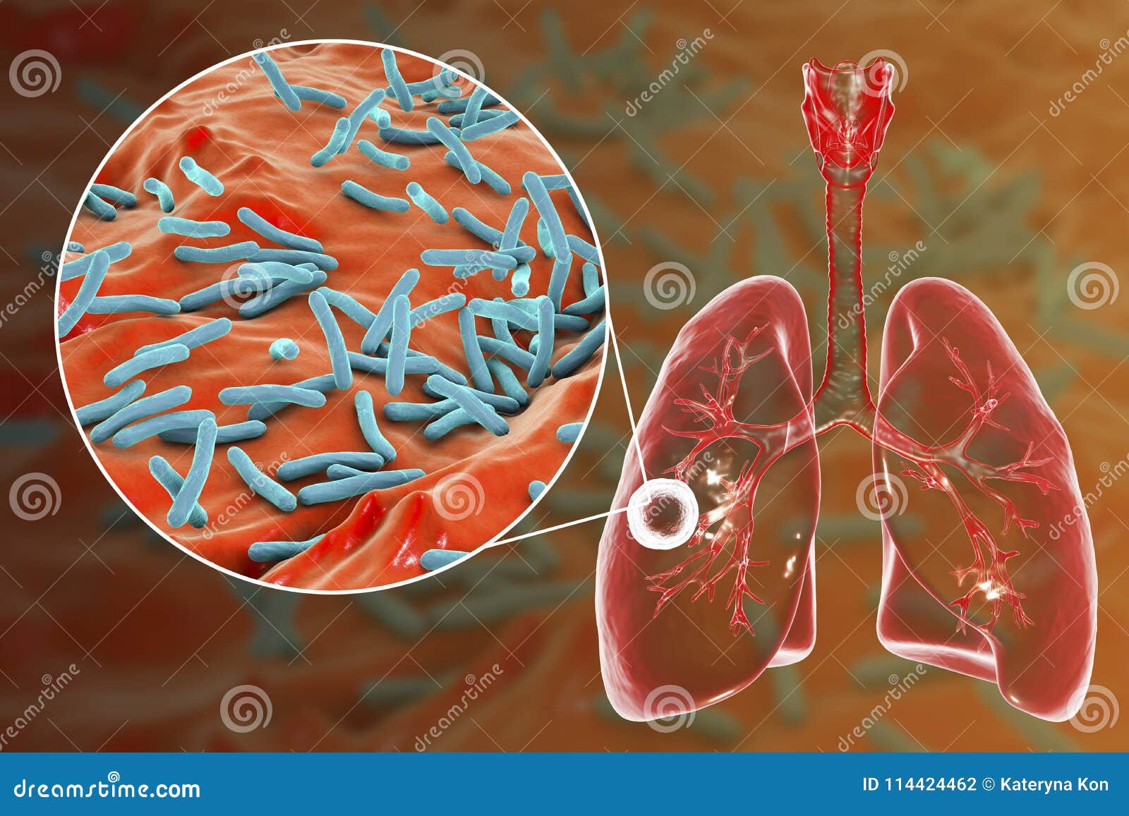 Tuberculosis Pulmonar Fibroso-cavernosa Stock de ilustración