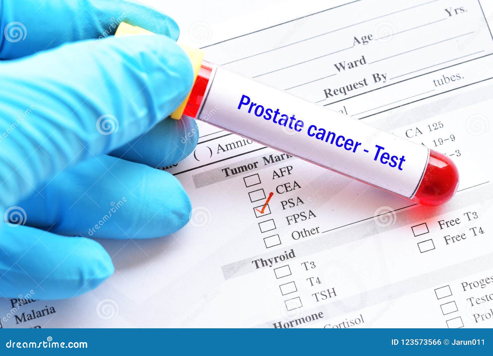 examen de próstata en sangre