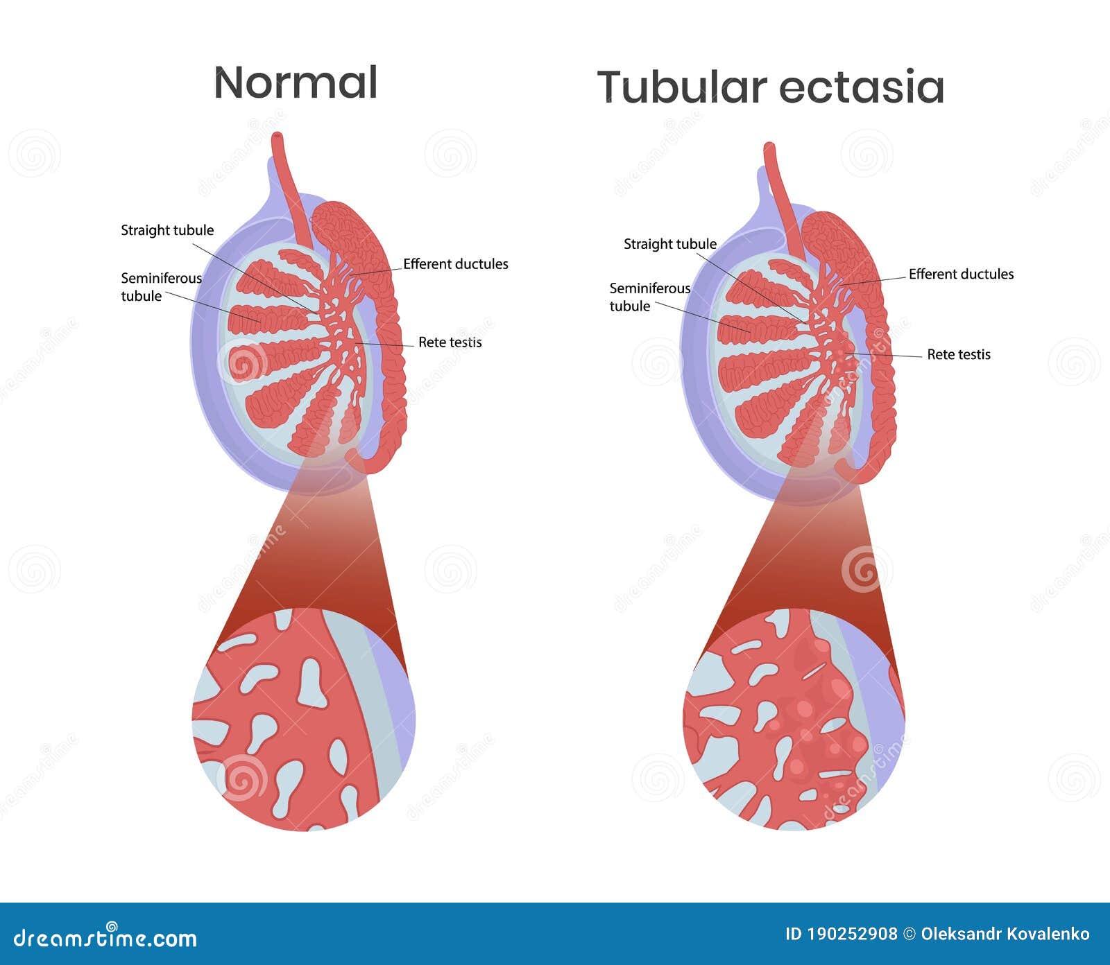 tubular ectasia of rete testis with normal testicular anatomy