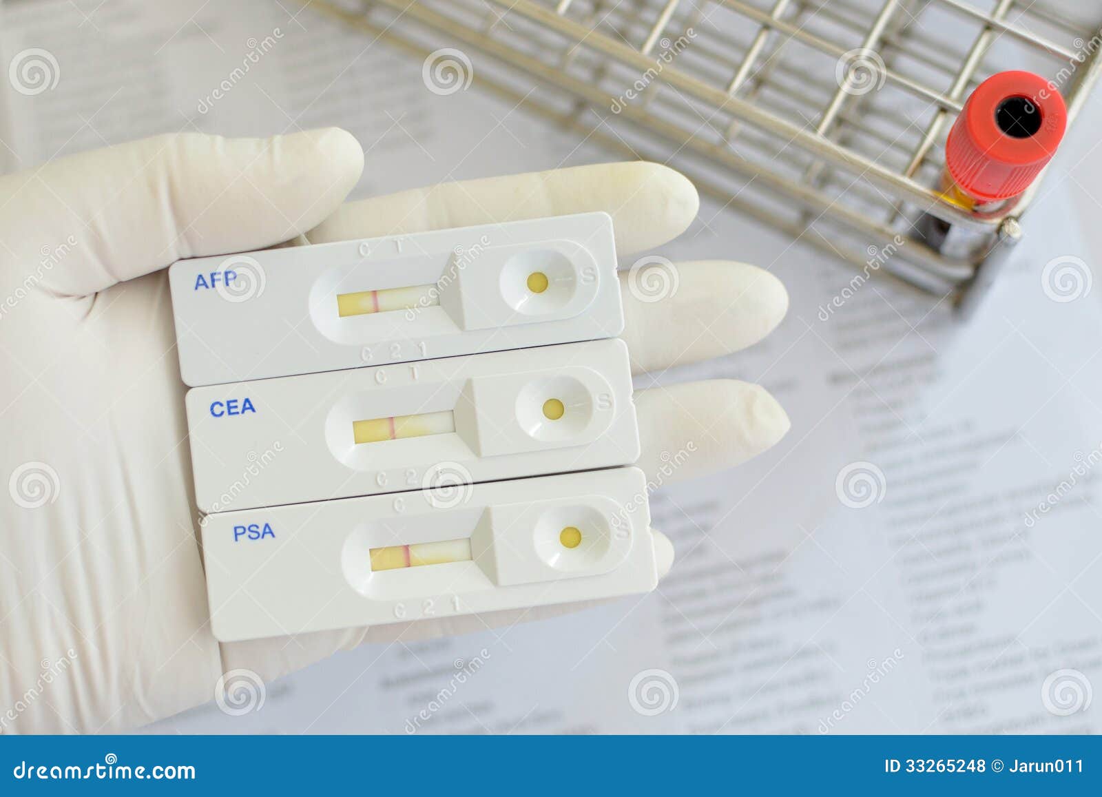 prostate tumour marker test