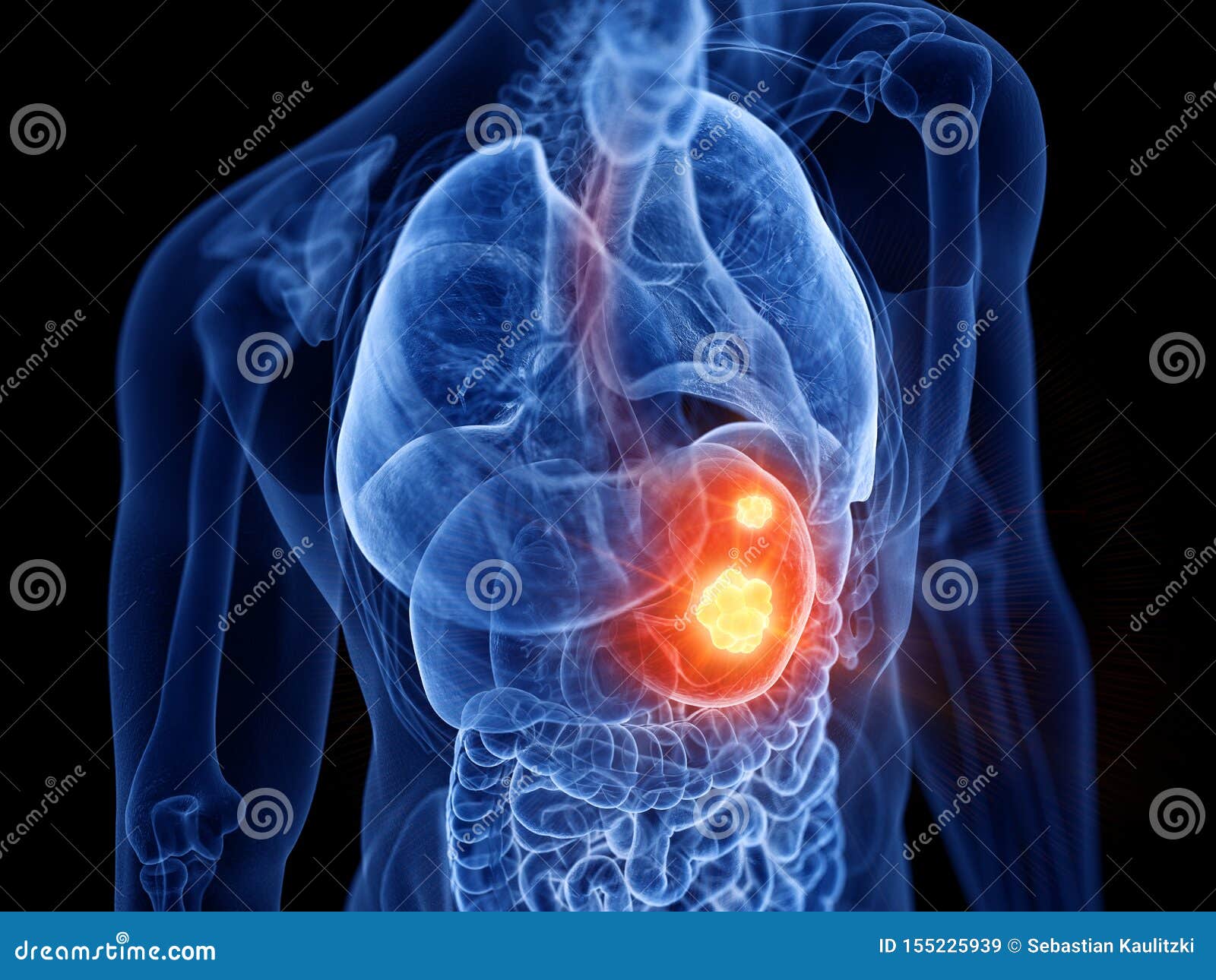 Gastropanel è Tumore Allo Stomaco Tumore dello stomaco illustrazione di stock. Illustrazione di gastrico