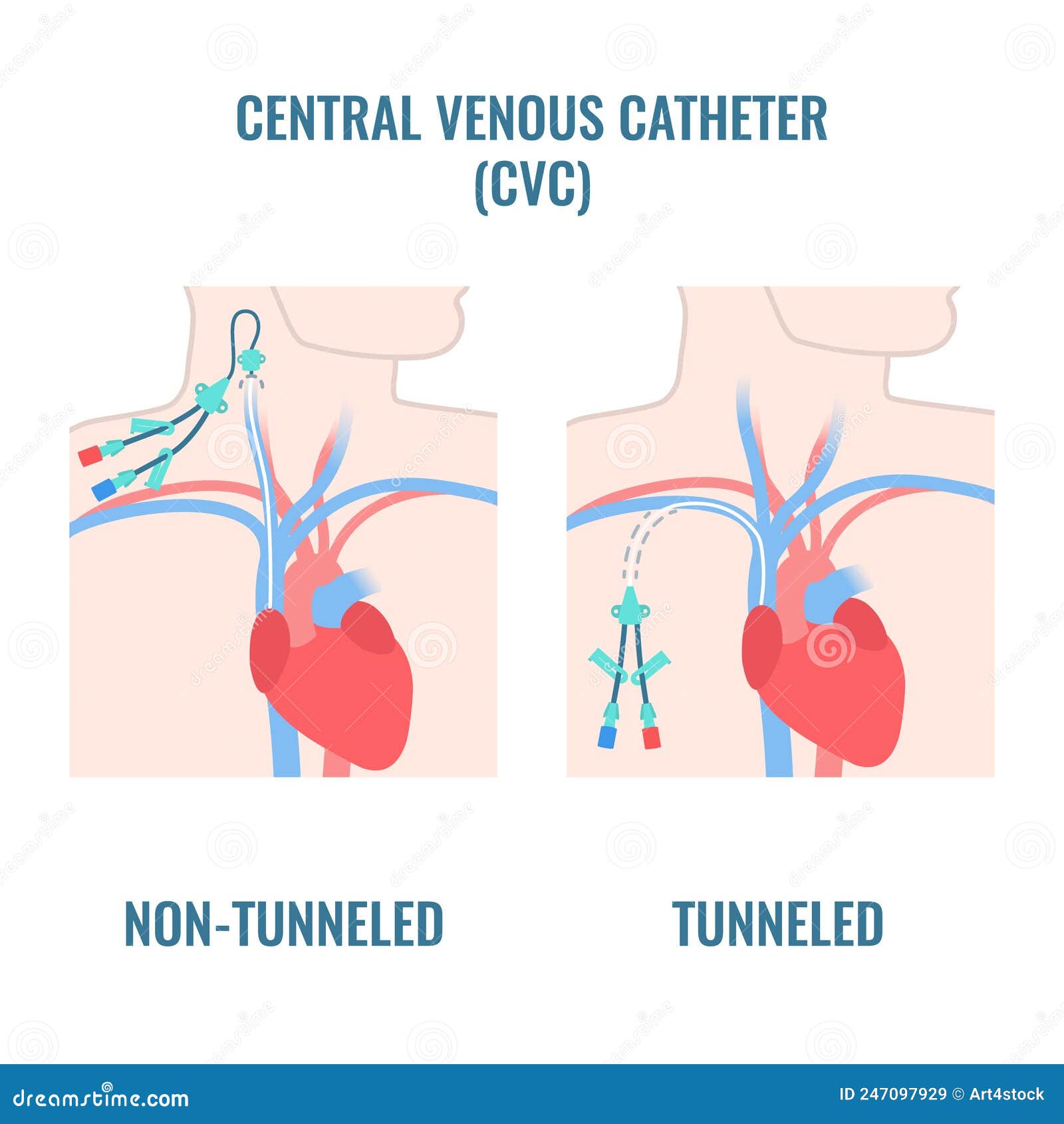 Central Line Venous Catheter Types On Male Body Cartoon Vector central-line-venous-catheter-types-on-male-body-cartoon-vector