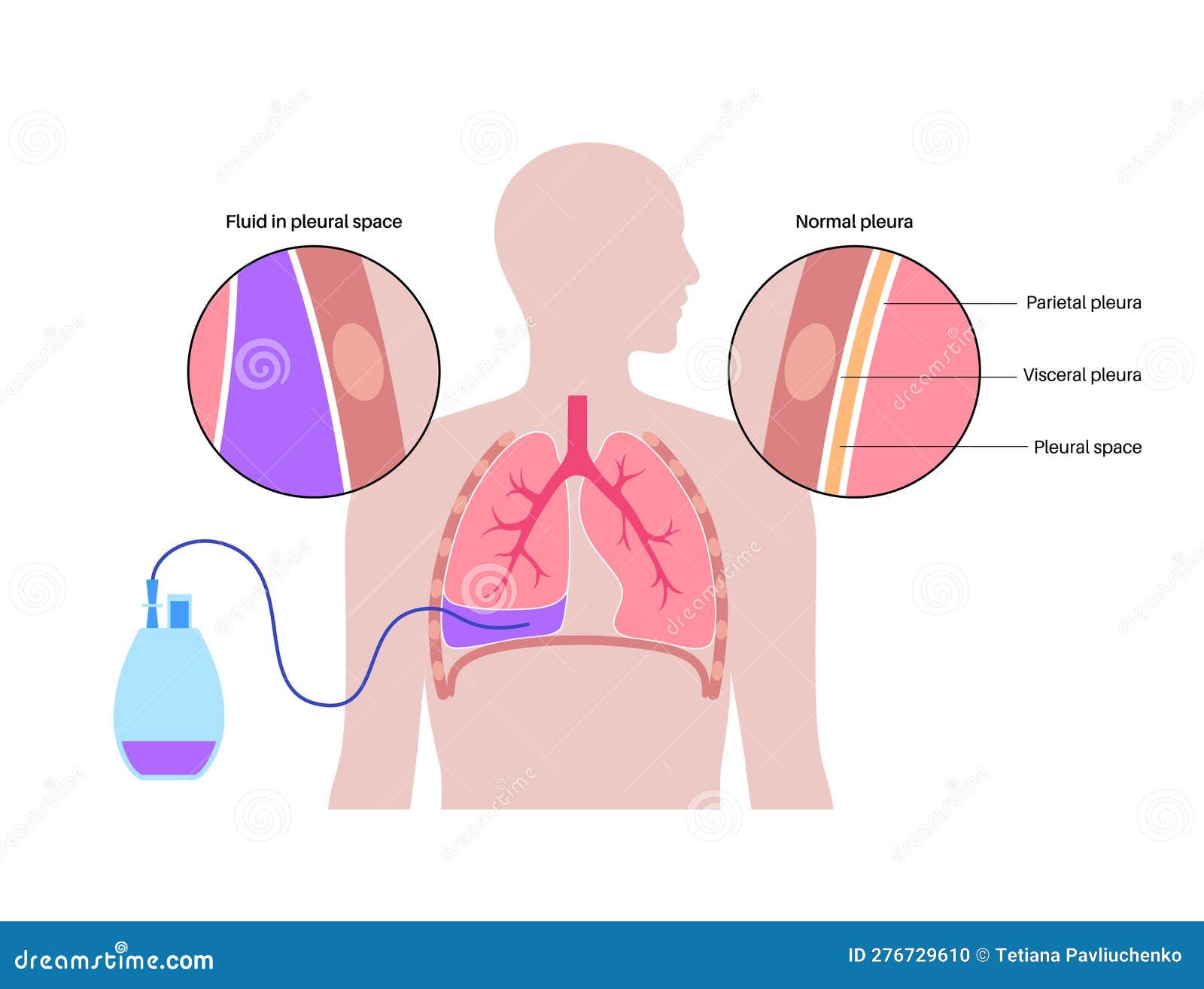 tunneled pleural catheter