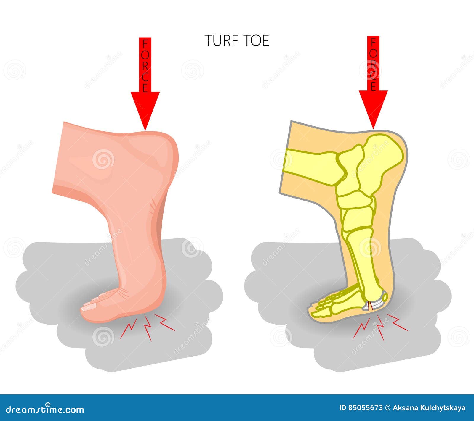turf toe. rupture of the plantar plate of the first toe of the f