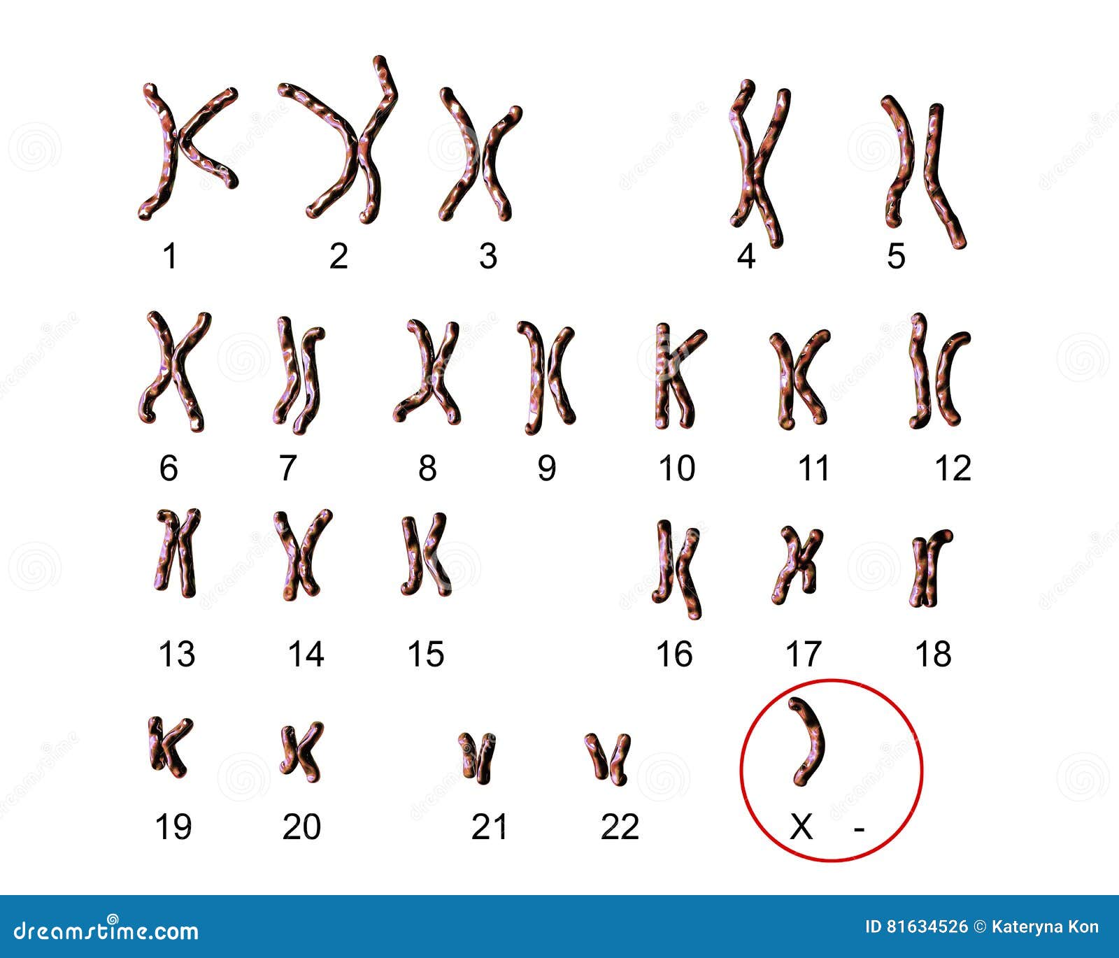 Sindrome De Turner Cromosoma