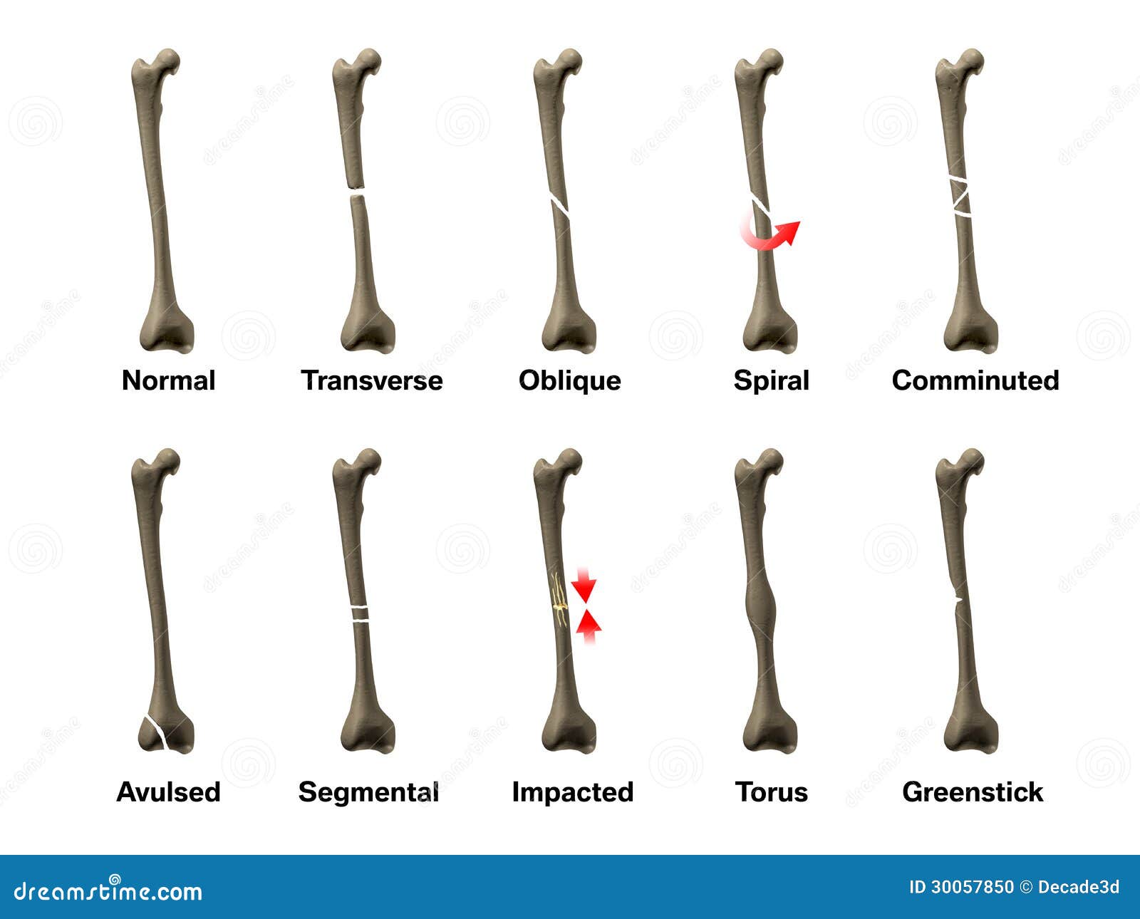 Risultati immagini per IMMAGINI 3D FRATTURE