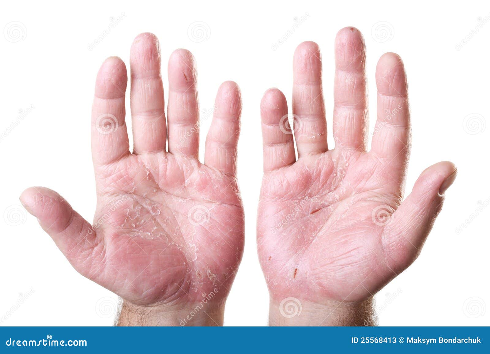 two male palms with eczema  on white