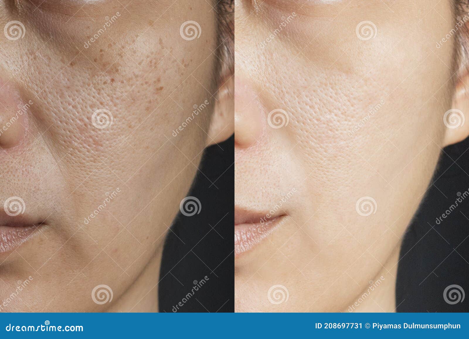 two pictures compare effect before and after treatment. skin with problems of freckles , pore , dull skin and wrinkles
