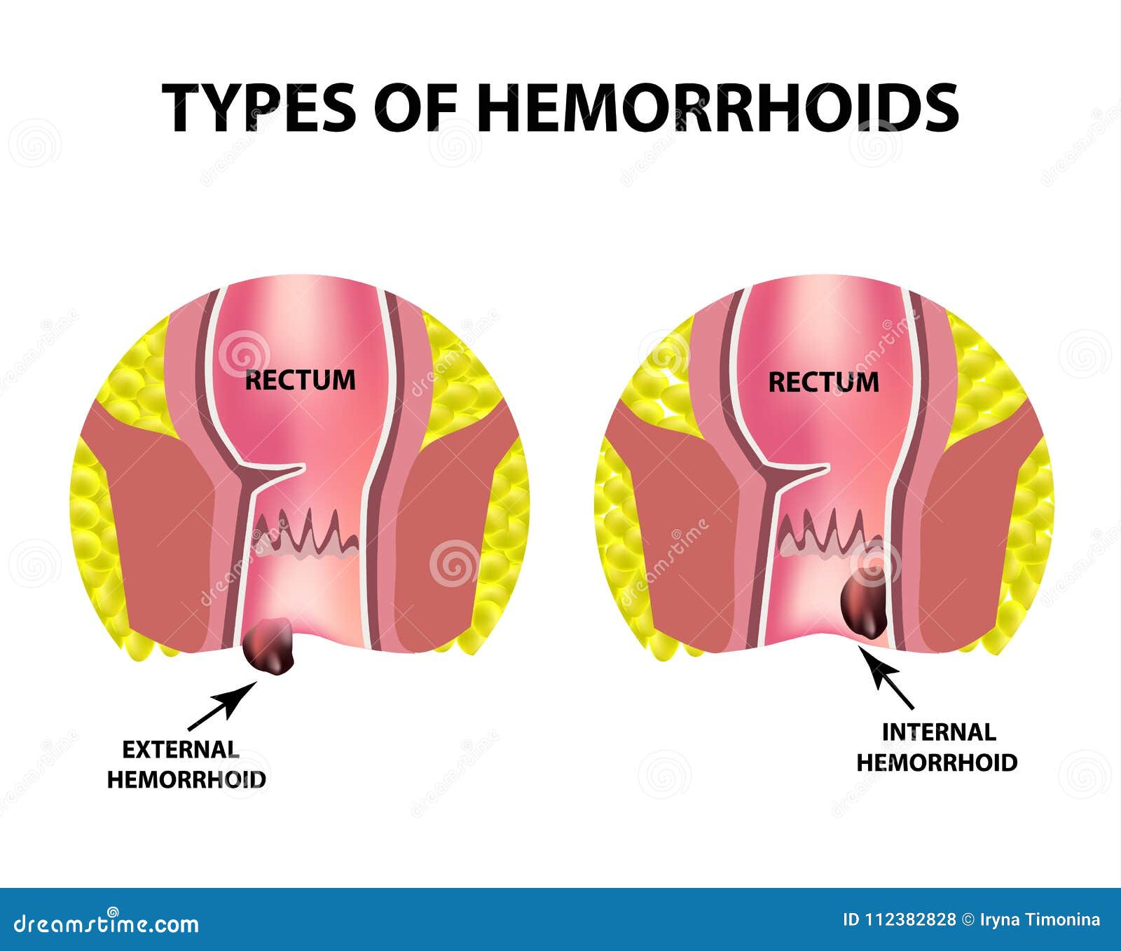 Two Types Of Hemorrhoids Are External And Internal. Rectum Structure