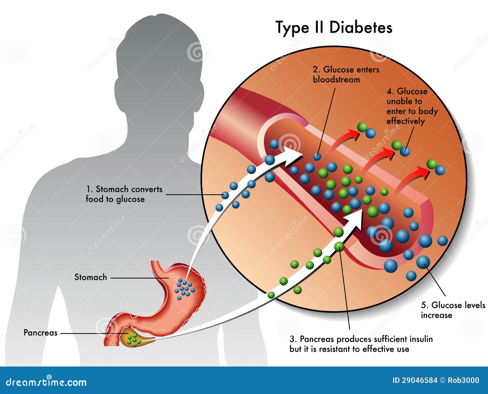 type 2 diabetes