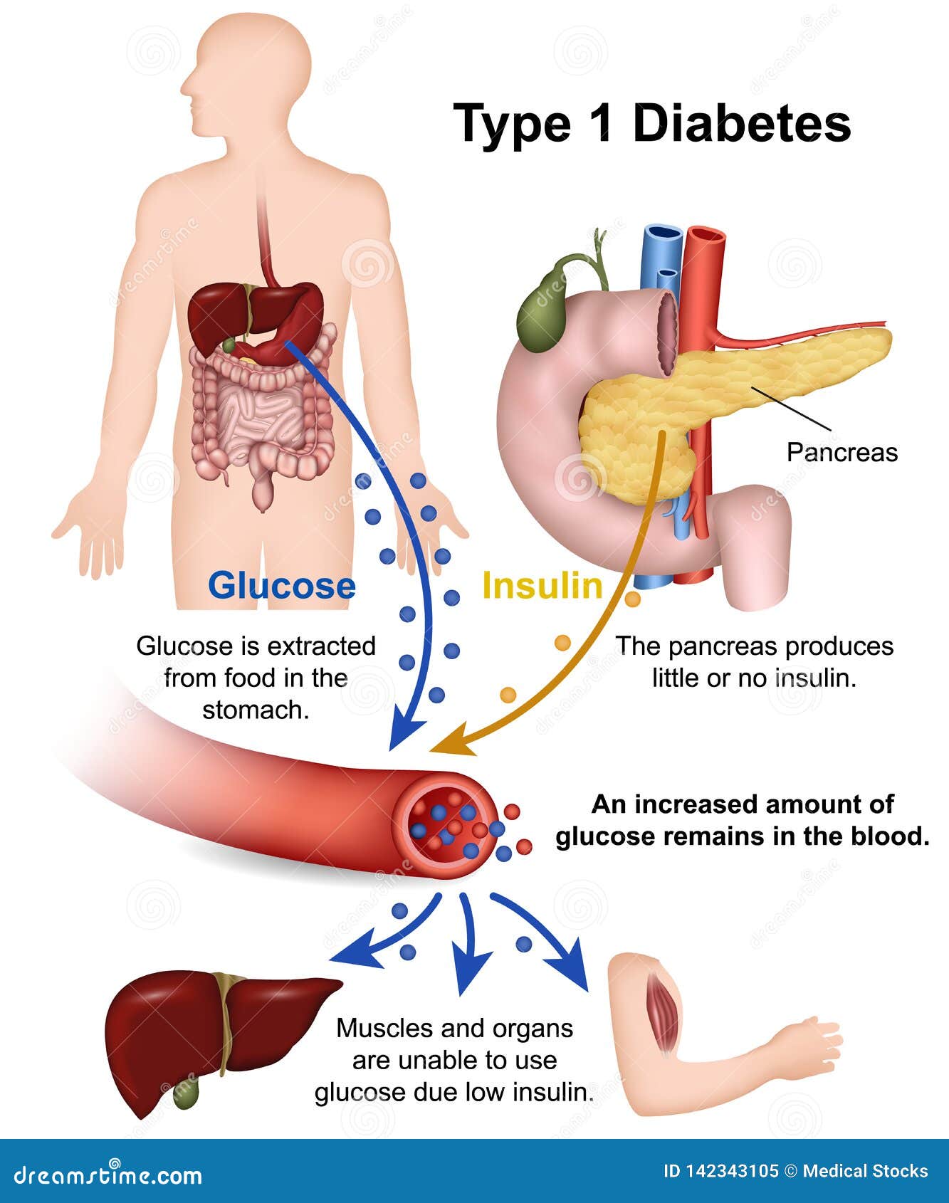 type 1 diabetes medical   with english description