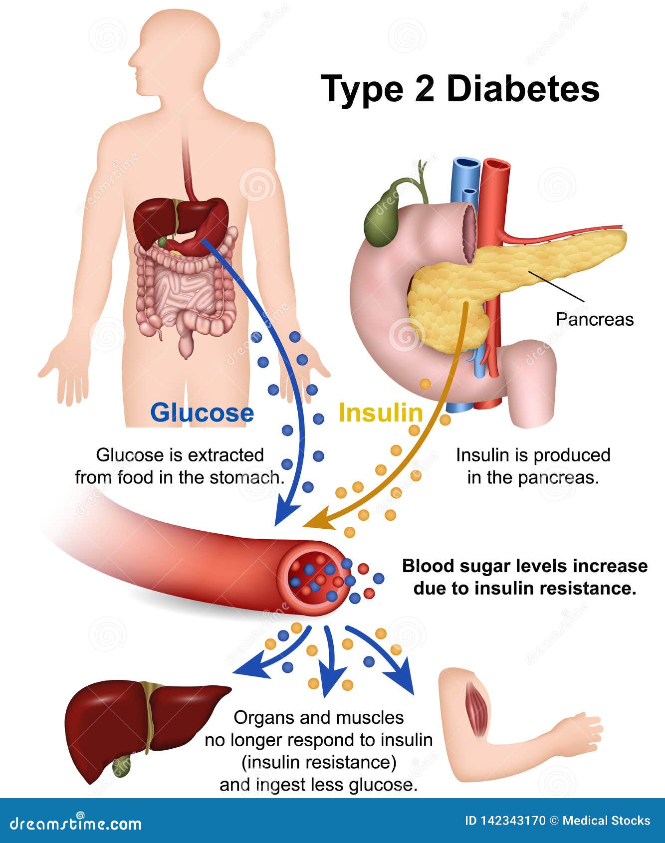 type 2 diabetes medical   with english description