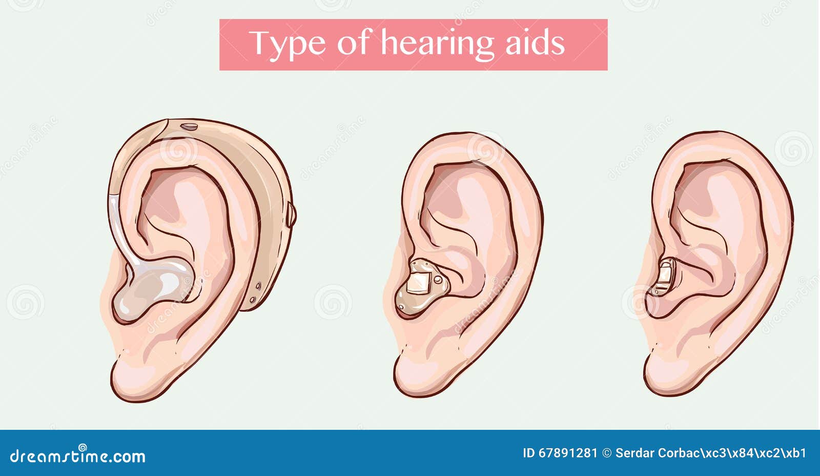 Type of hearing aids stock vector. Illustration of aids 67891281