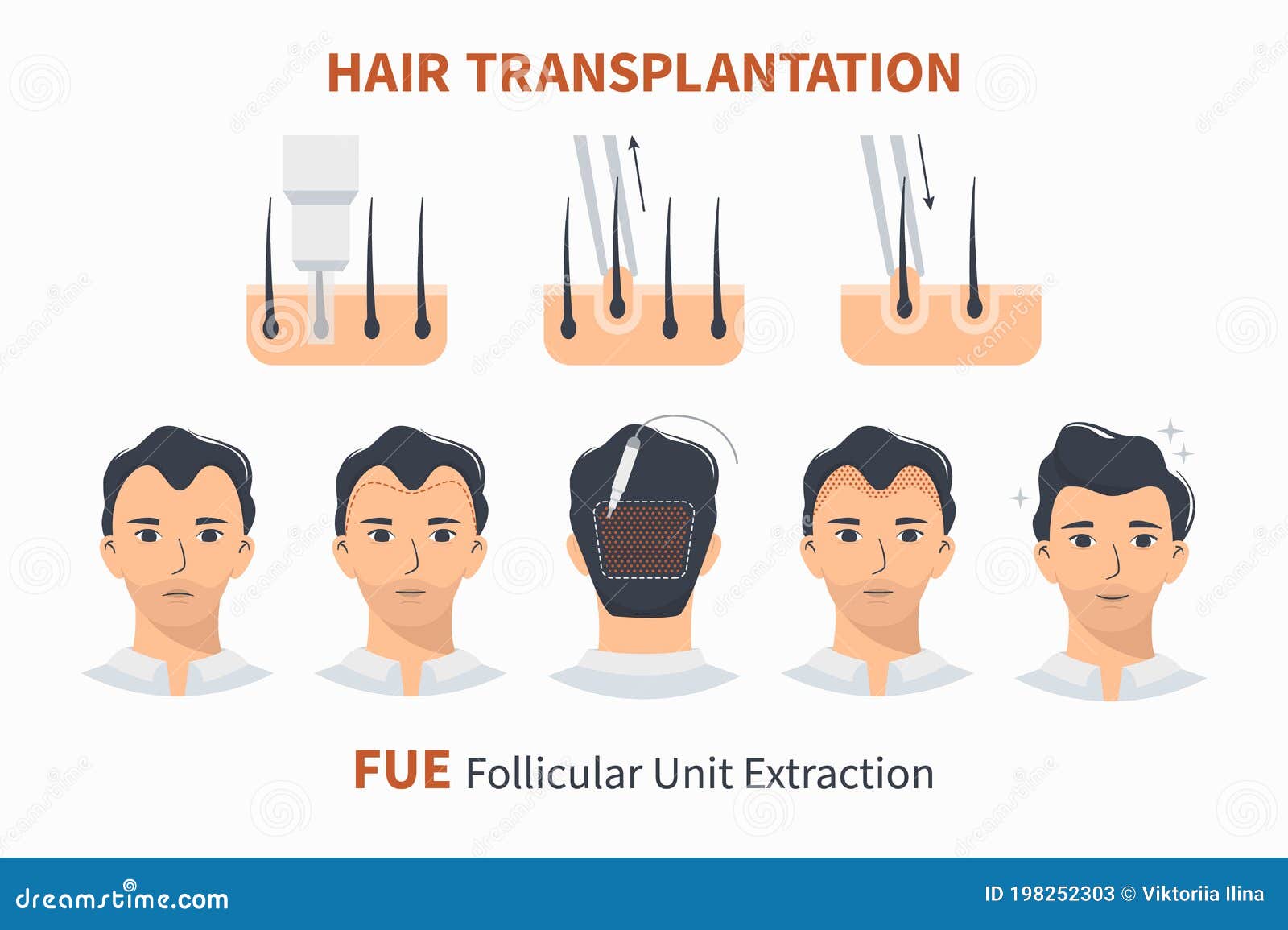 stages of hair transplantation fue unit extraction
