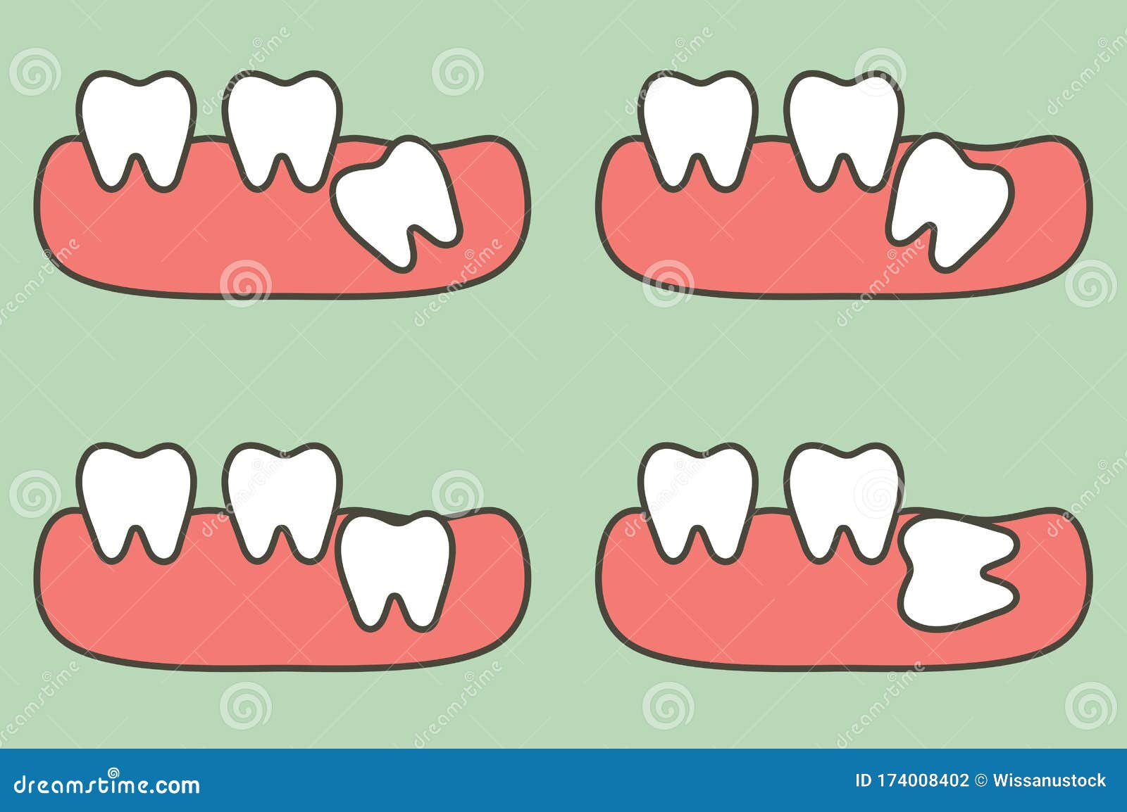 Type Of Wisdom Tooth Affect To Other Teeth Stock Vector ...