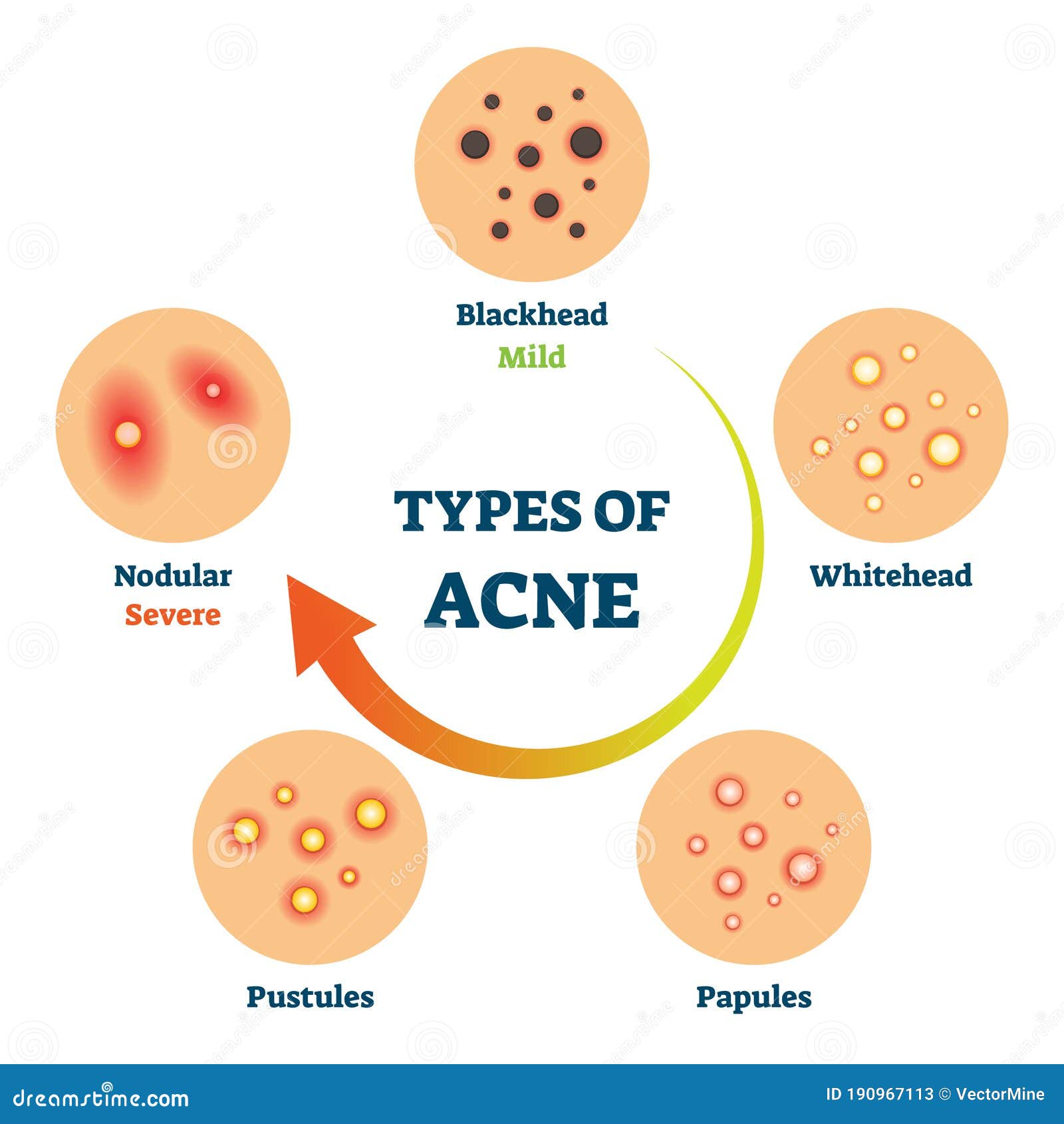 Types Of Acne As Medical Skin Disease Comparison Scheme Vector