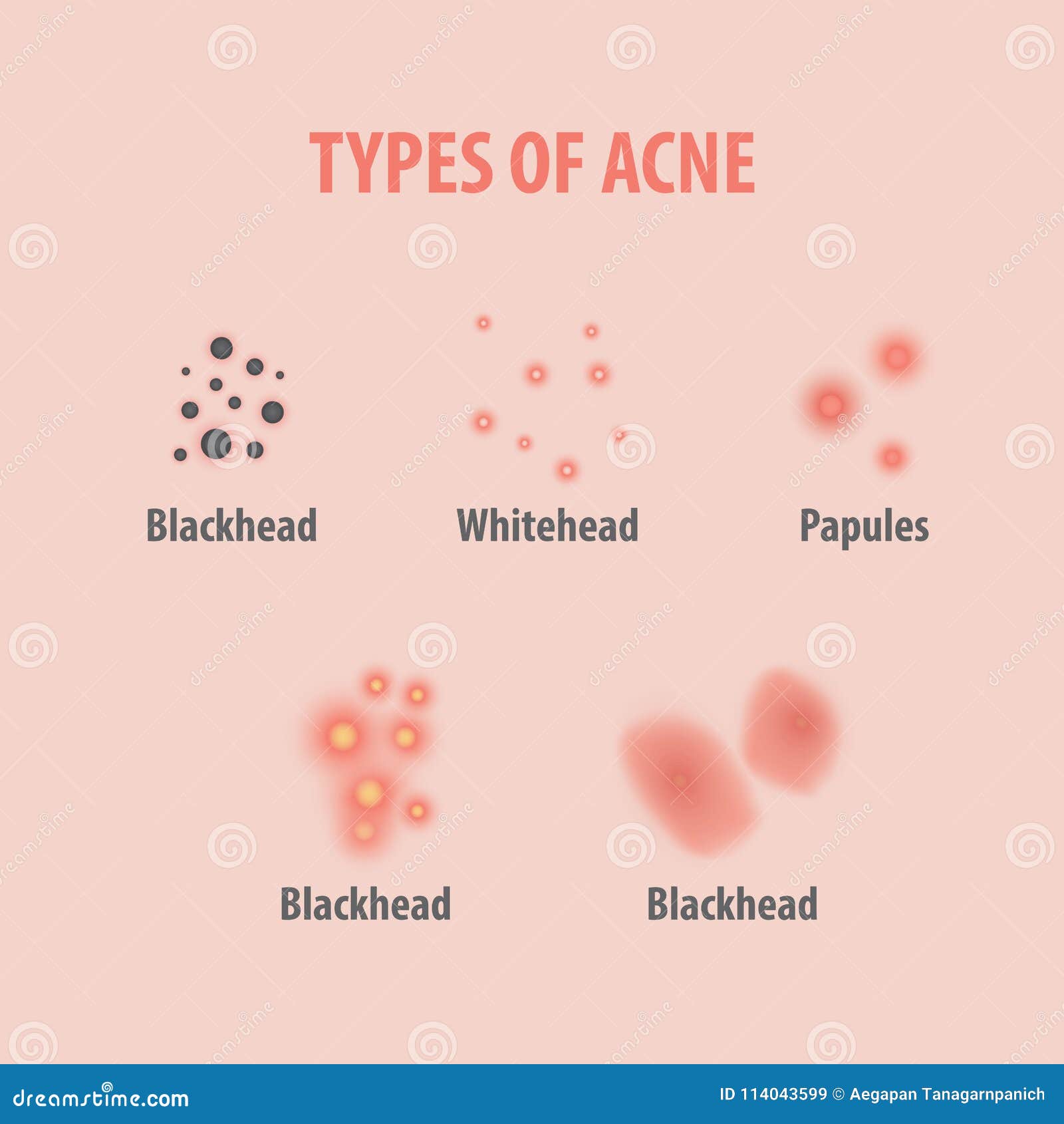 Types Of Acne Illustration Vector On White Background, Beauty Co Stock ...