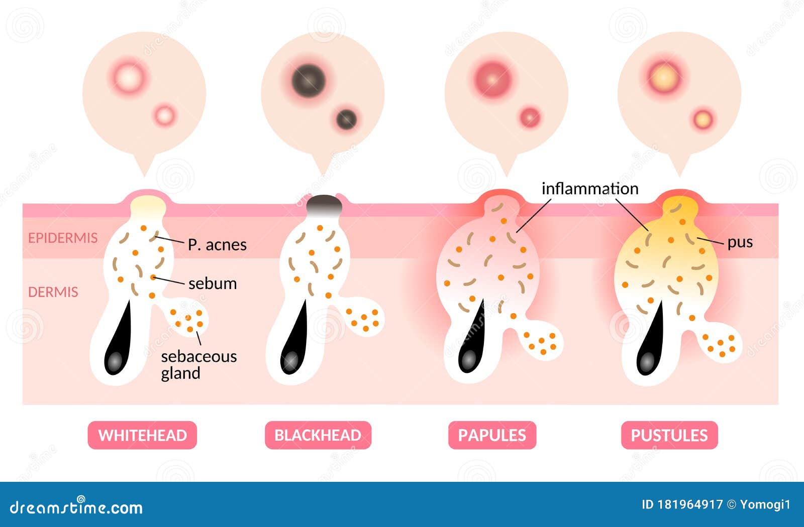 Types of Acne Illustration. White Head,black Head, Papules, and ...