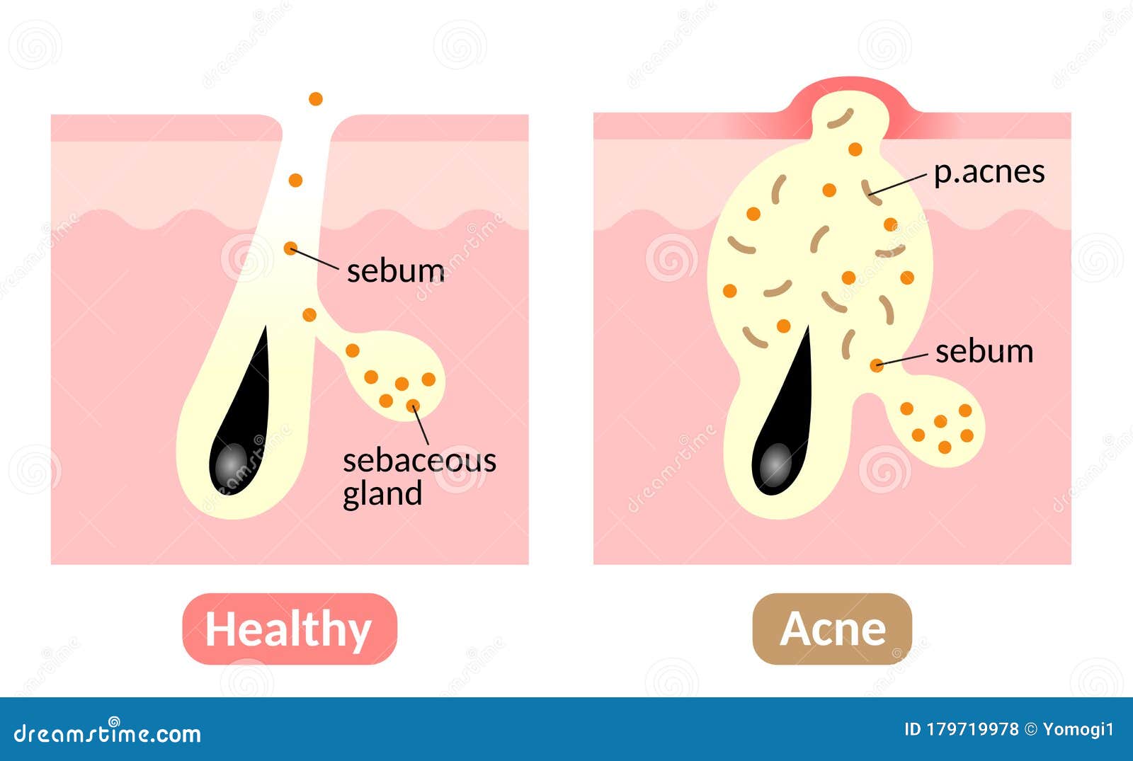 Acne Formation Process Types Of Acne Healthy Skin Sebum Plug