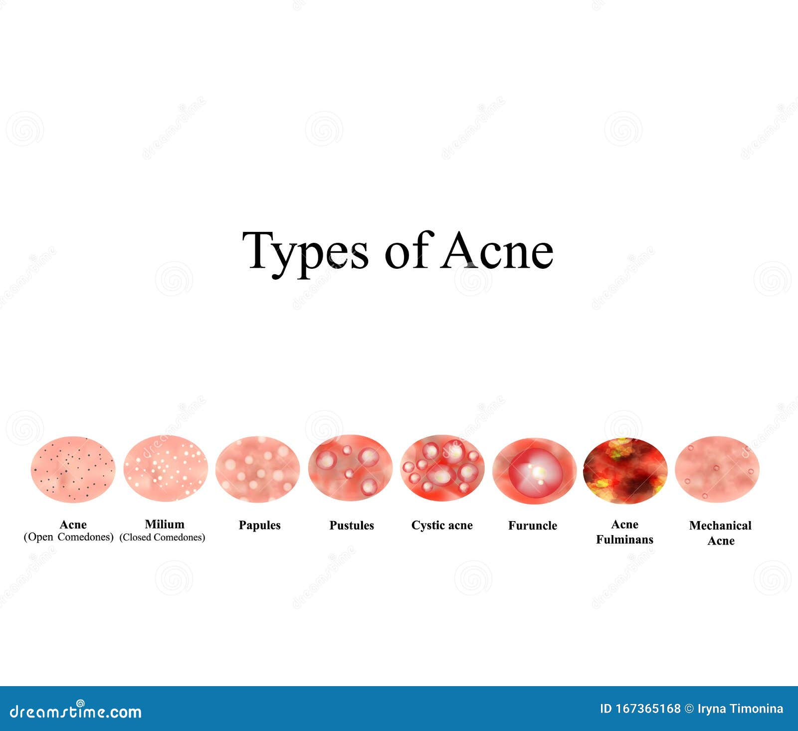 types of acne skin inflammation. pimples, boils, whitehead, closed comedones, papules, pustules, cystic acne