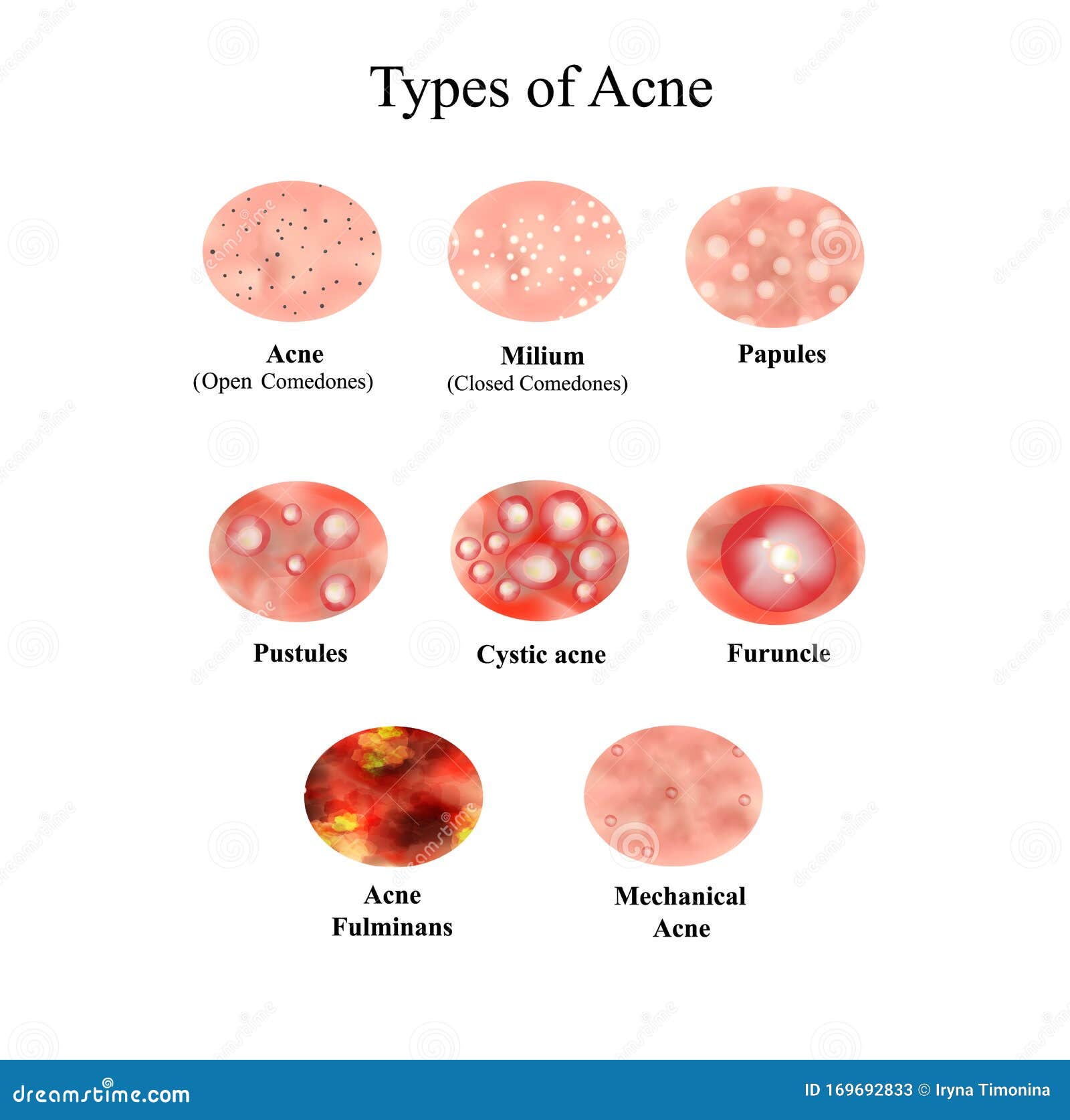 Types of Acne Skin Inflammation. Pimples, Boils, Whitehead, Closed ...