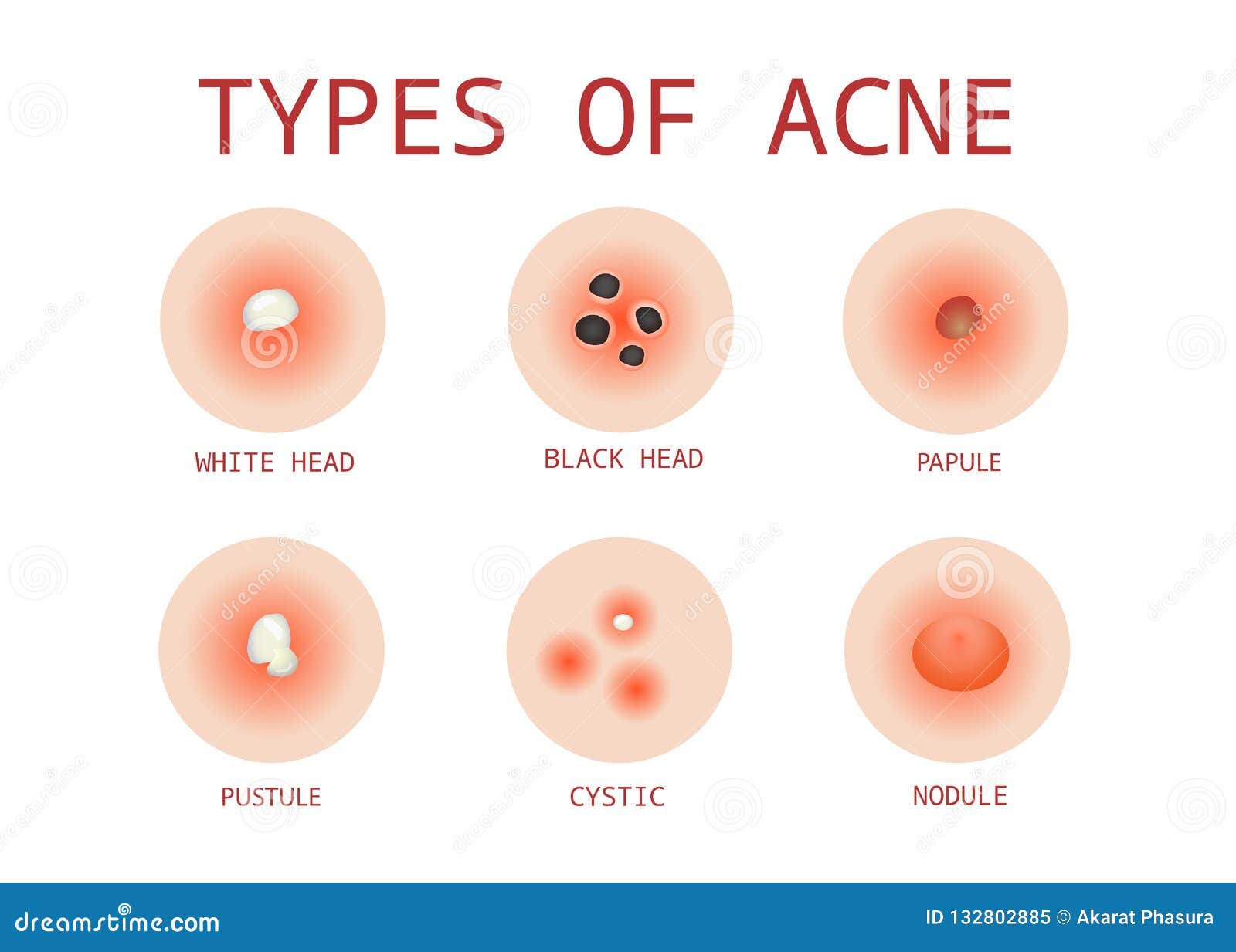 types of acne cream