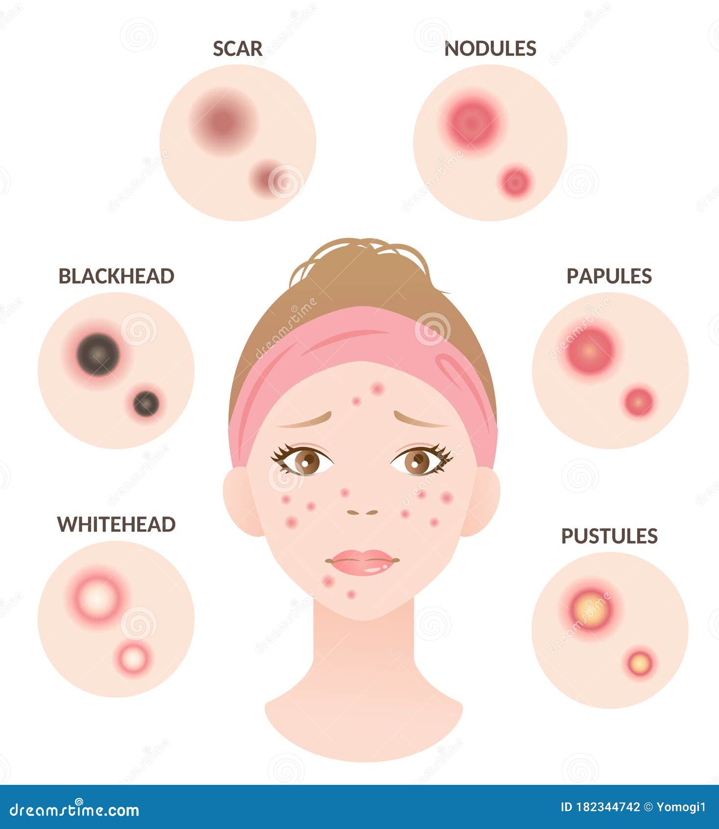 Women papules Definition And