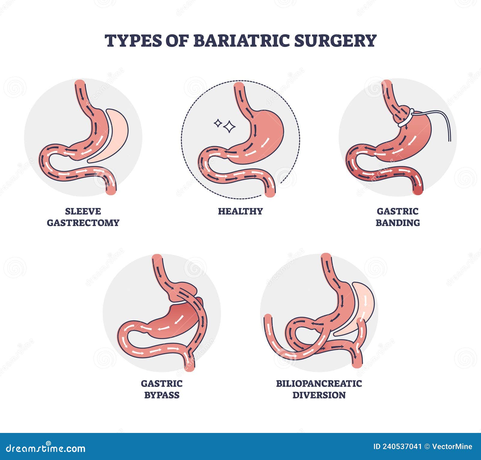 types of bariatric surgery and stomach reduction control outline diagram