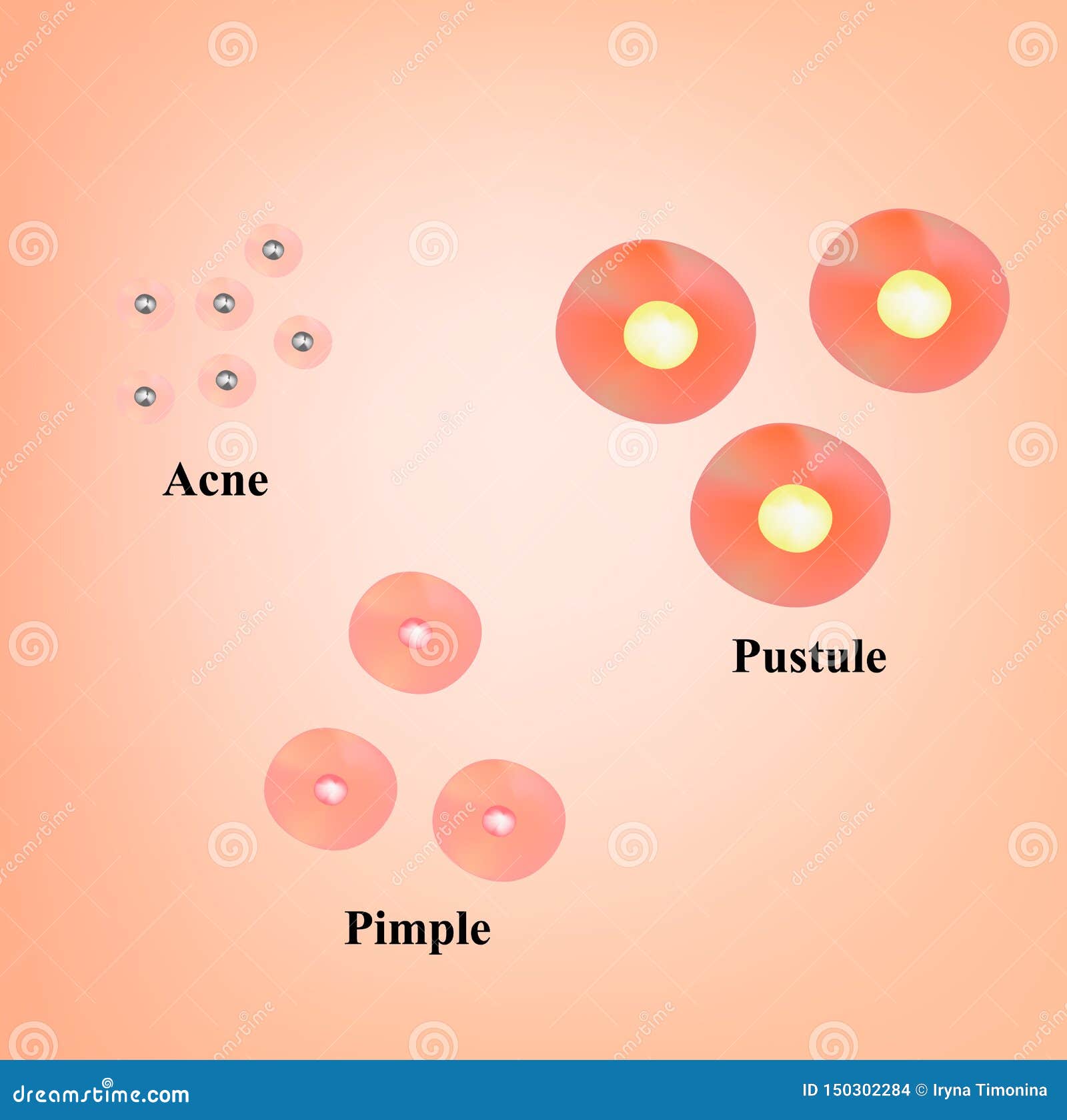 types of blackheads, pustule, acne. scarred skin after acne and acne. infographics.   on 