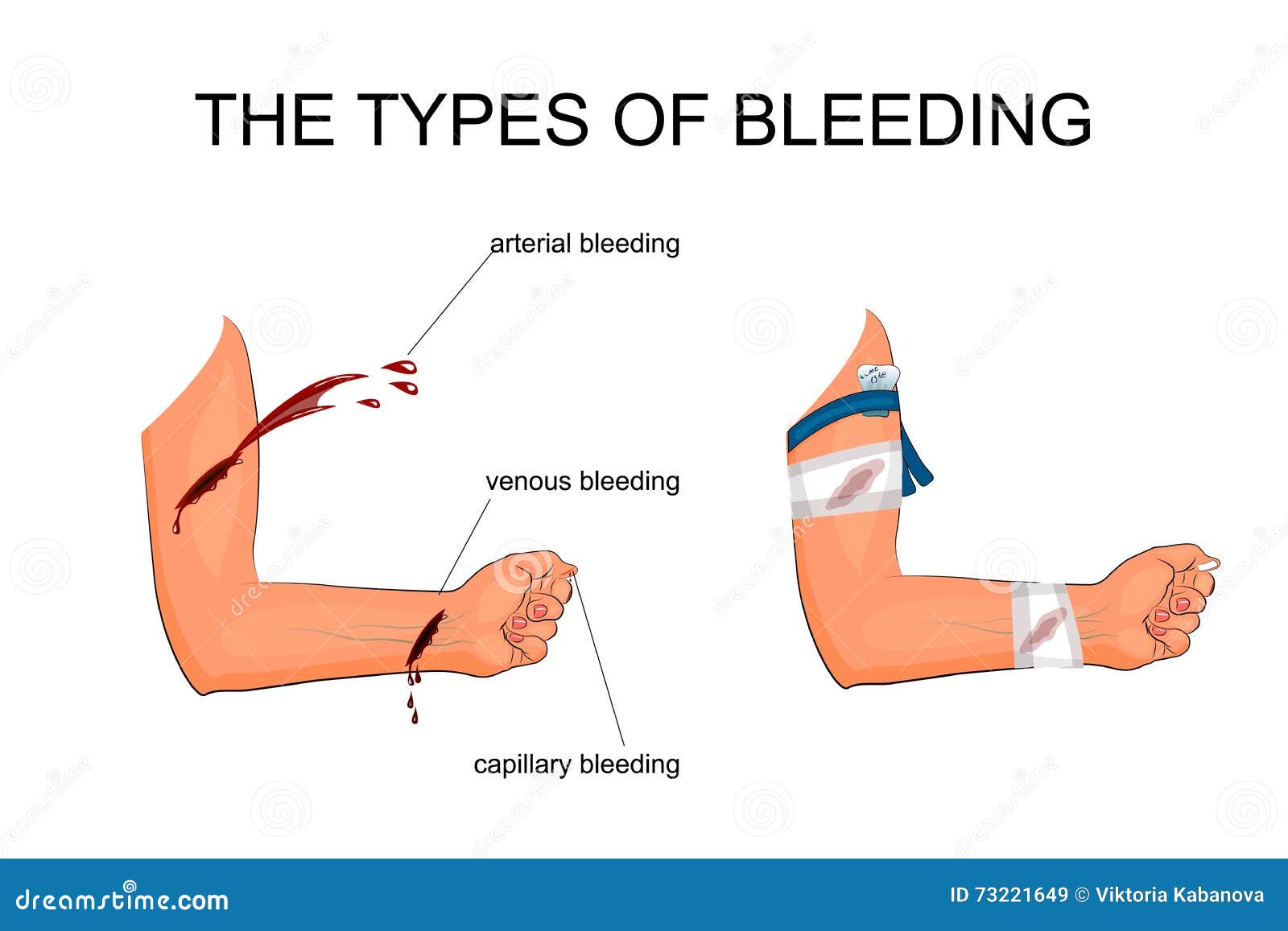 the types of bleeding