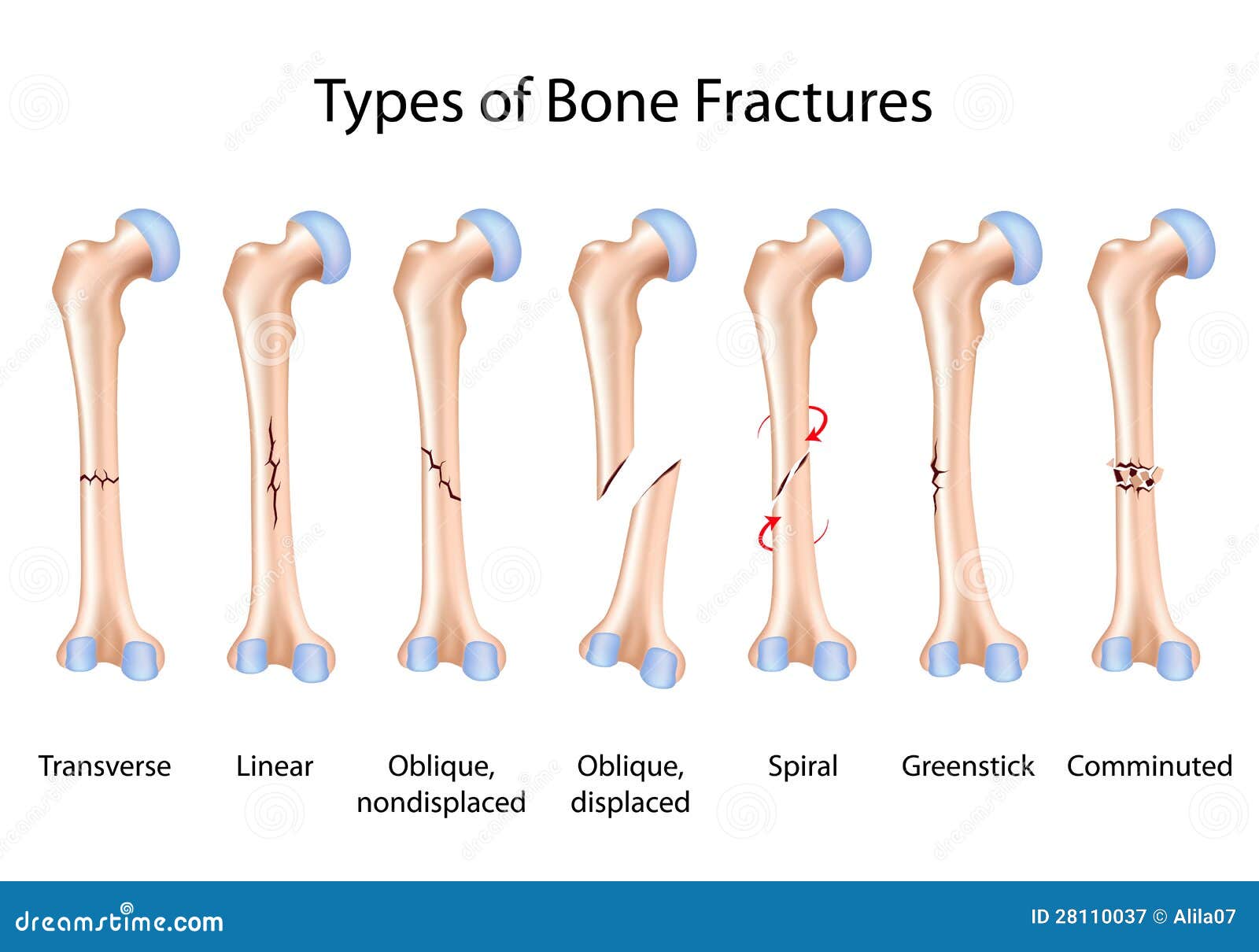 pott s fracture