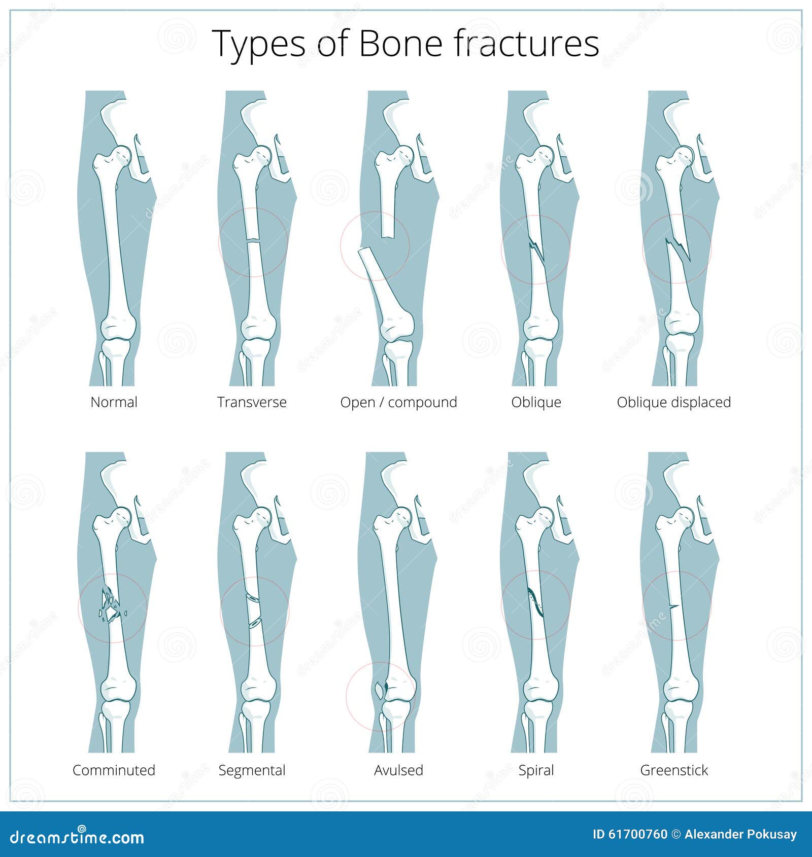 Types Of Bone Fractures Medical Educational Vector Stock Vector