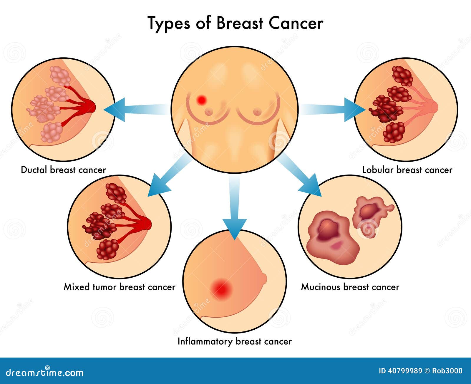 Types of breast cancer, illustration - Stock Image - F035/7343 - Science  Photo Library