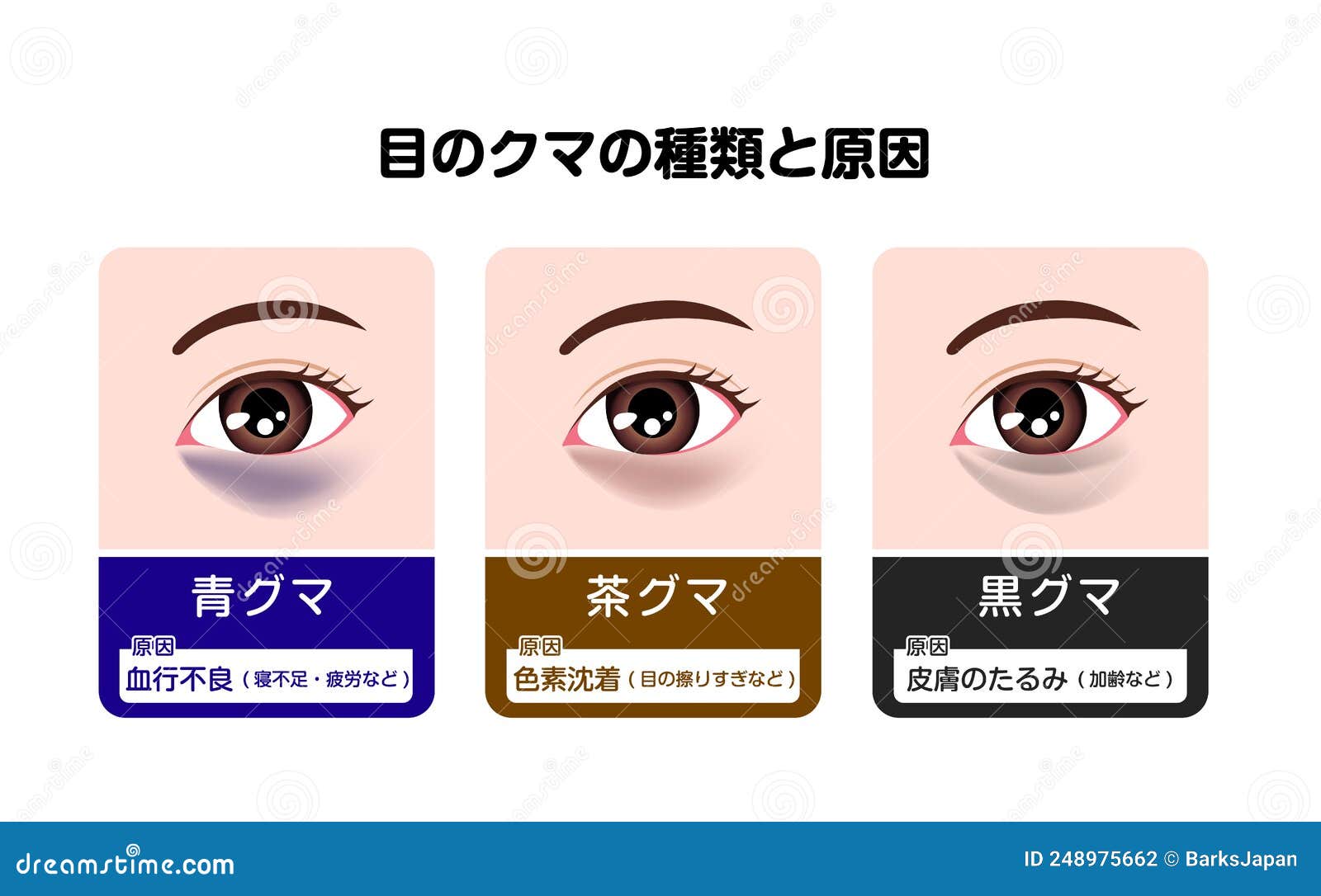 Types and Causes of Dark Circles Under Eyes. Vector Illustration