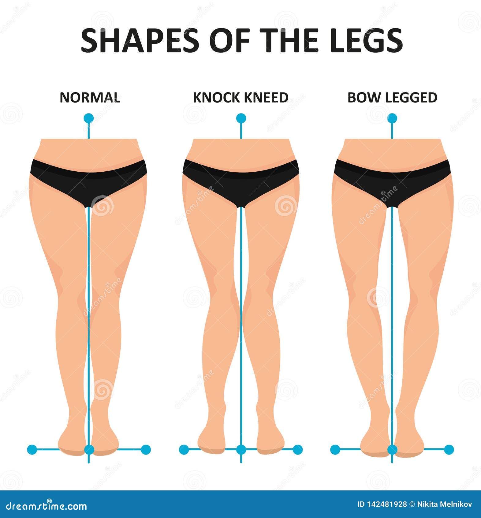 Types of Curvatures Human Feet. Stock Vector Illustration of genu