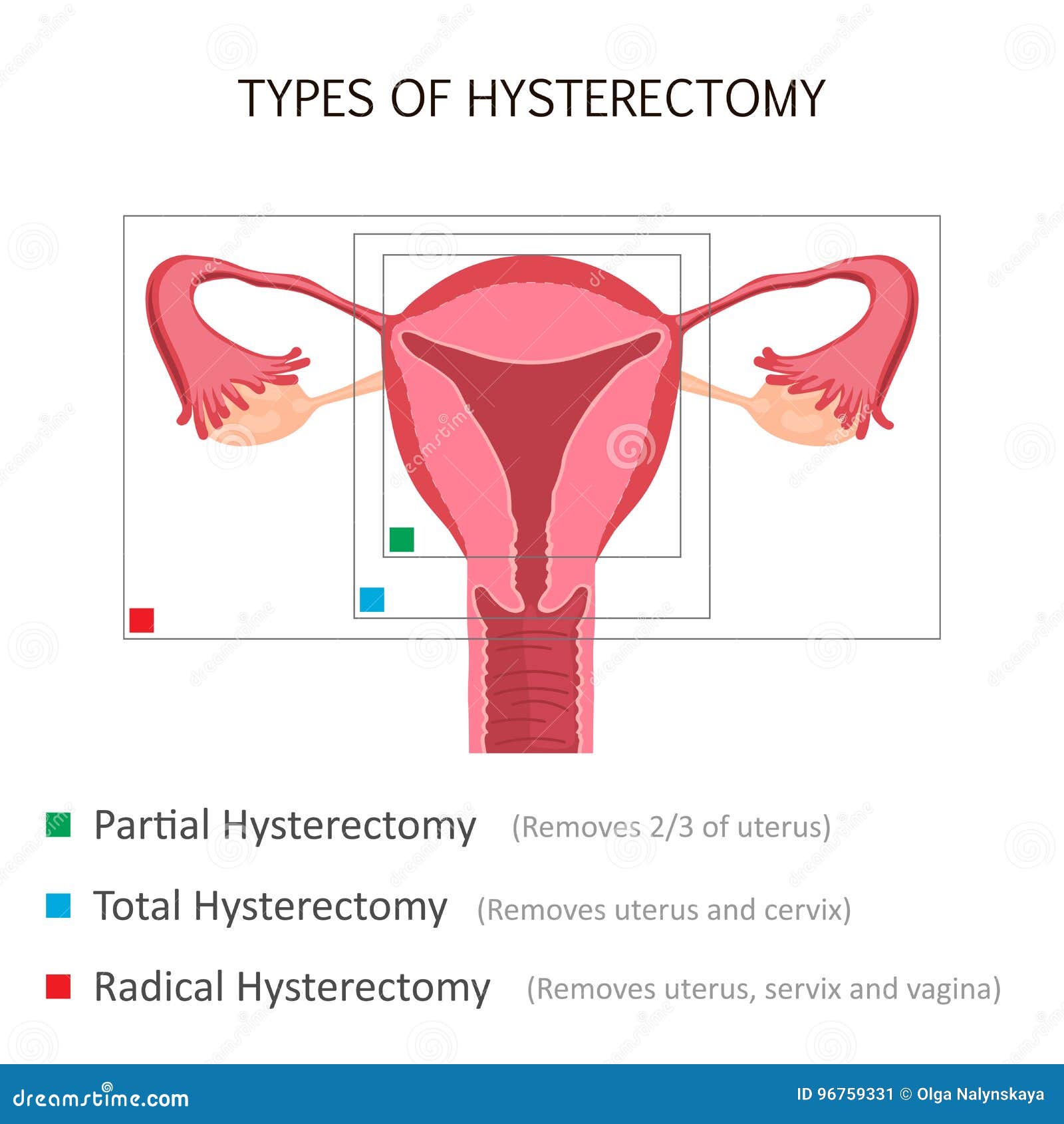 Types d'hystérectomie illustration de vecteur. Illustration du