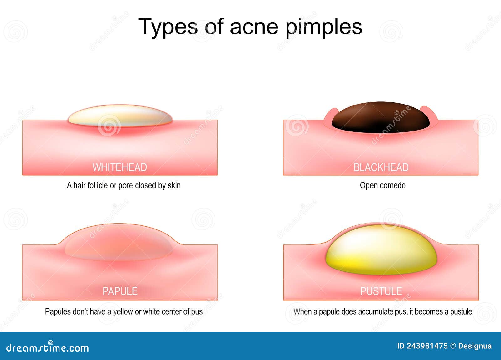 Types de boutons d'acné illustration de vecteur. Illustration du ...