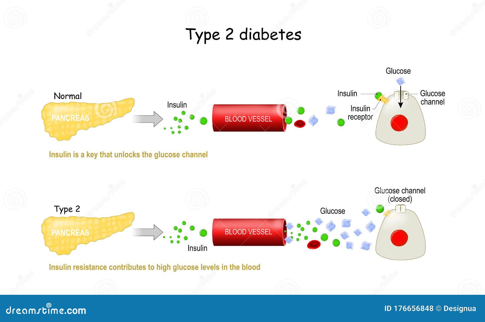 Diabetes types of