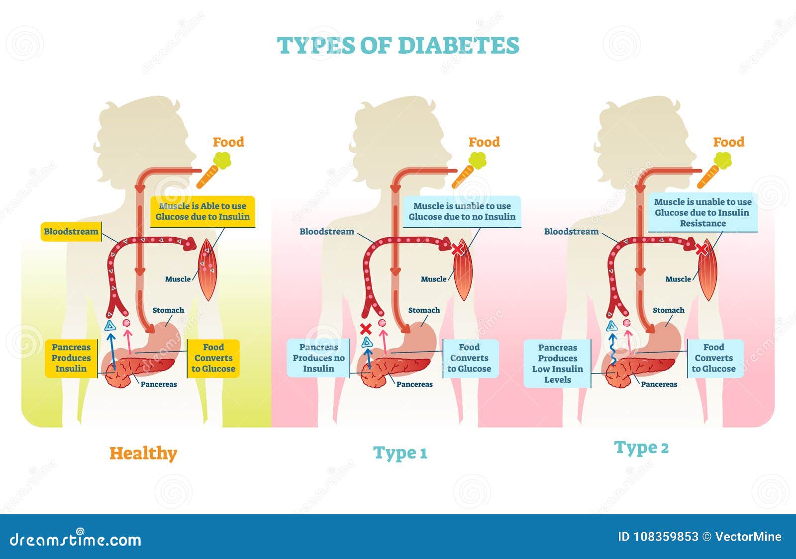 diabetes mellitus 2 típusú kezelési diagram kezelése felfedezés cukorbetegség