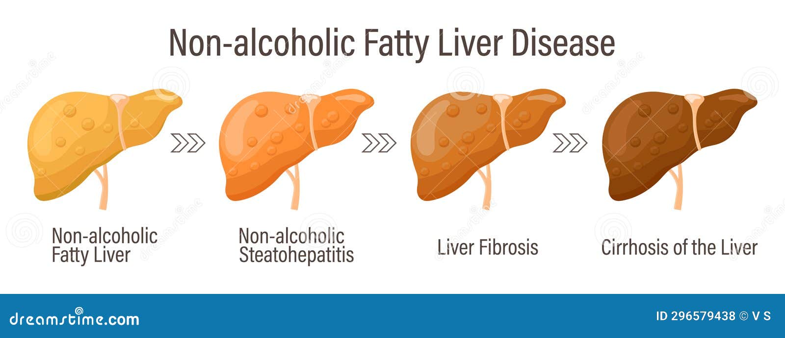 Types of Fatty Liver. Human Liver Diseases. Non-alcoholic Fatty Liver ...