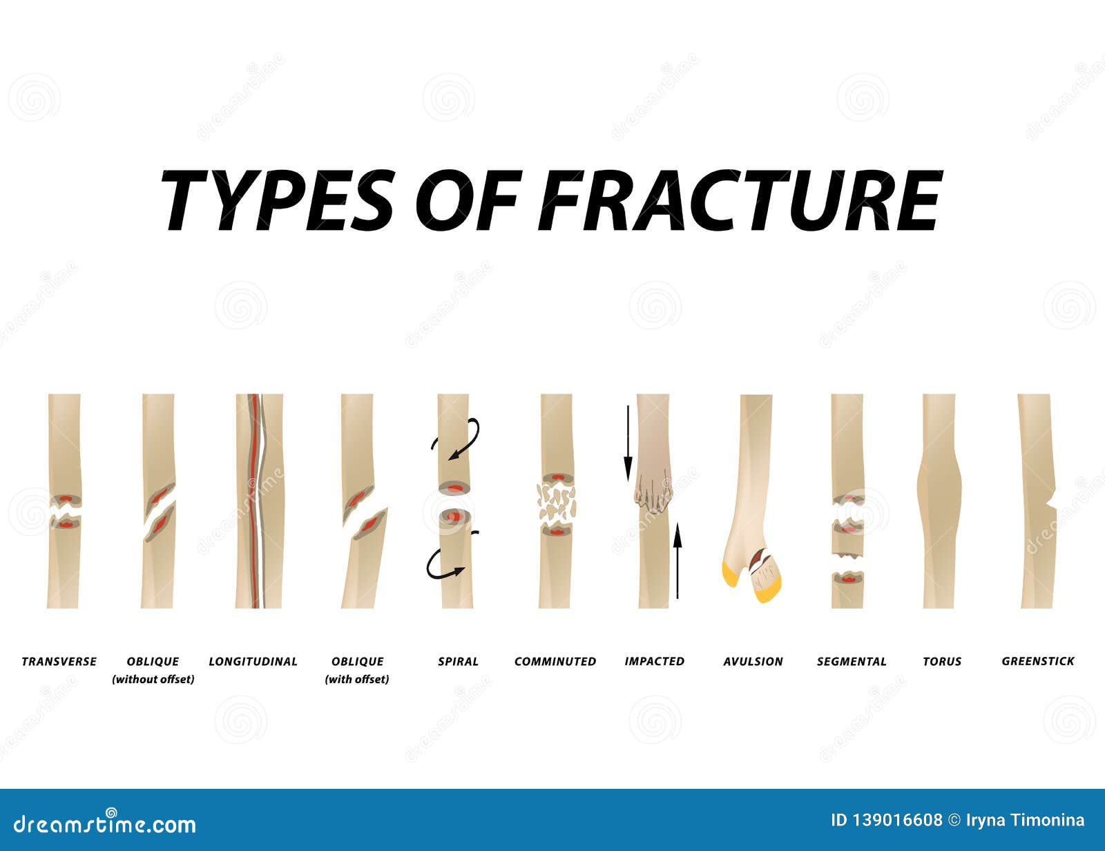 types of fracture. fracture bone set. infographics.   on  background.