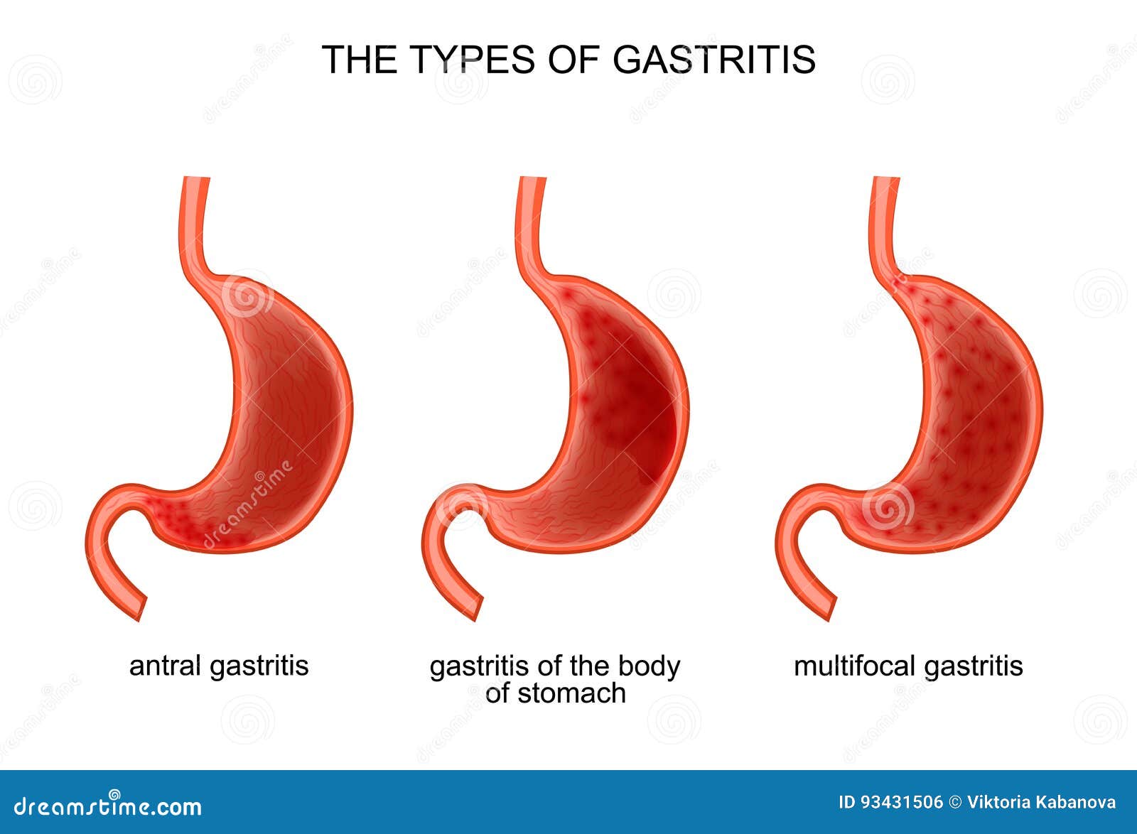 the types of gastritis