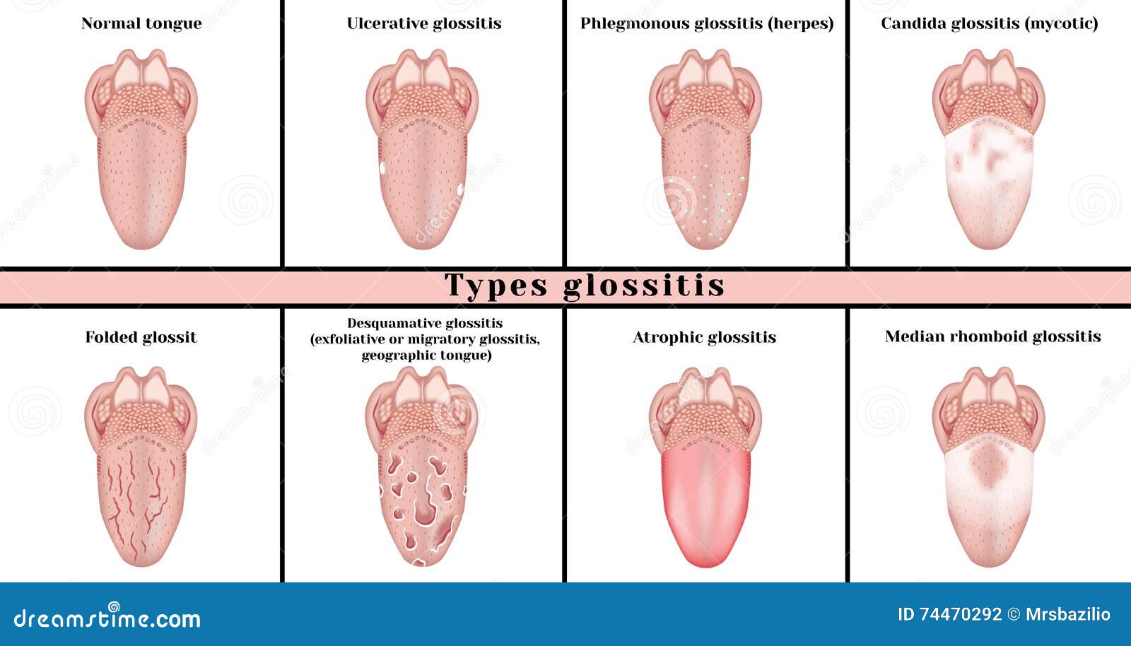 types glossitis. inflammatory disease tongue