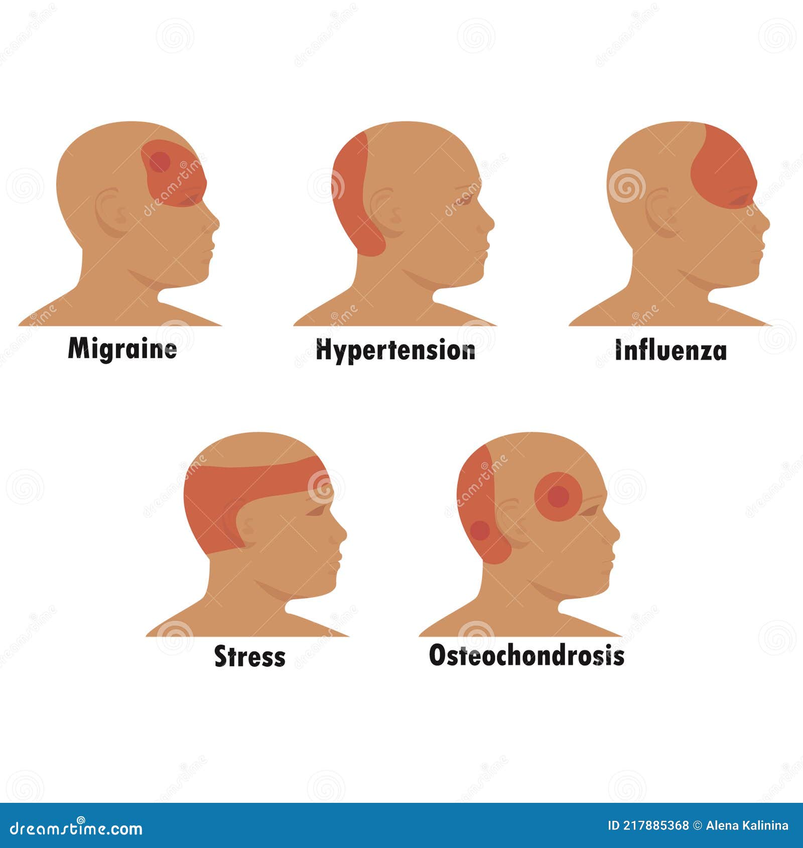 Types Headache Stock Illustrations 127 Types Headache Stock Illustrations Vectors Clipart Dreamstime