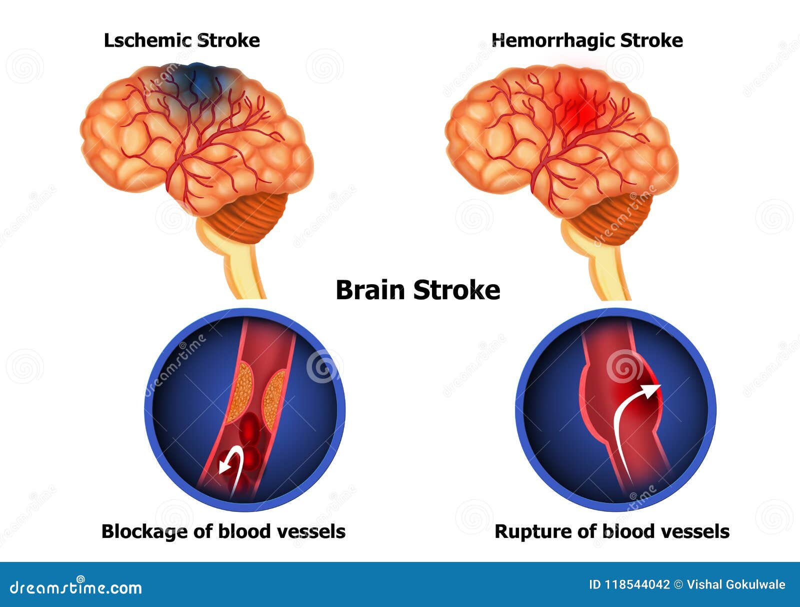 Types Of Human Brain Stroke Stock Illustration