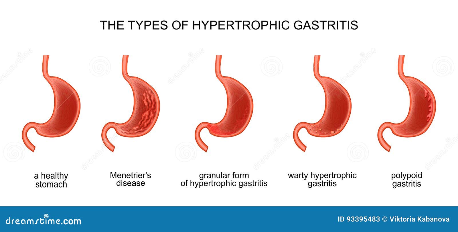 the types of hypertrophic gastritis