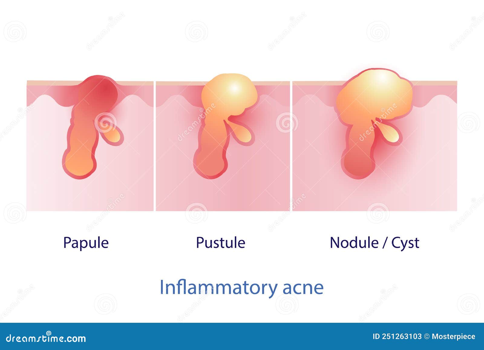 Acne Nodule Vs Cyst