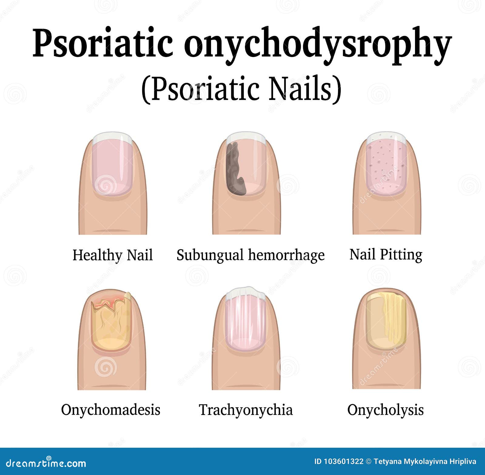 onycholysis psoriasis